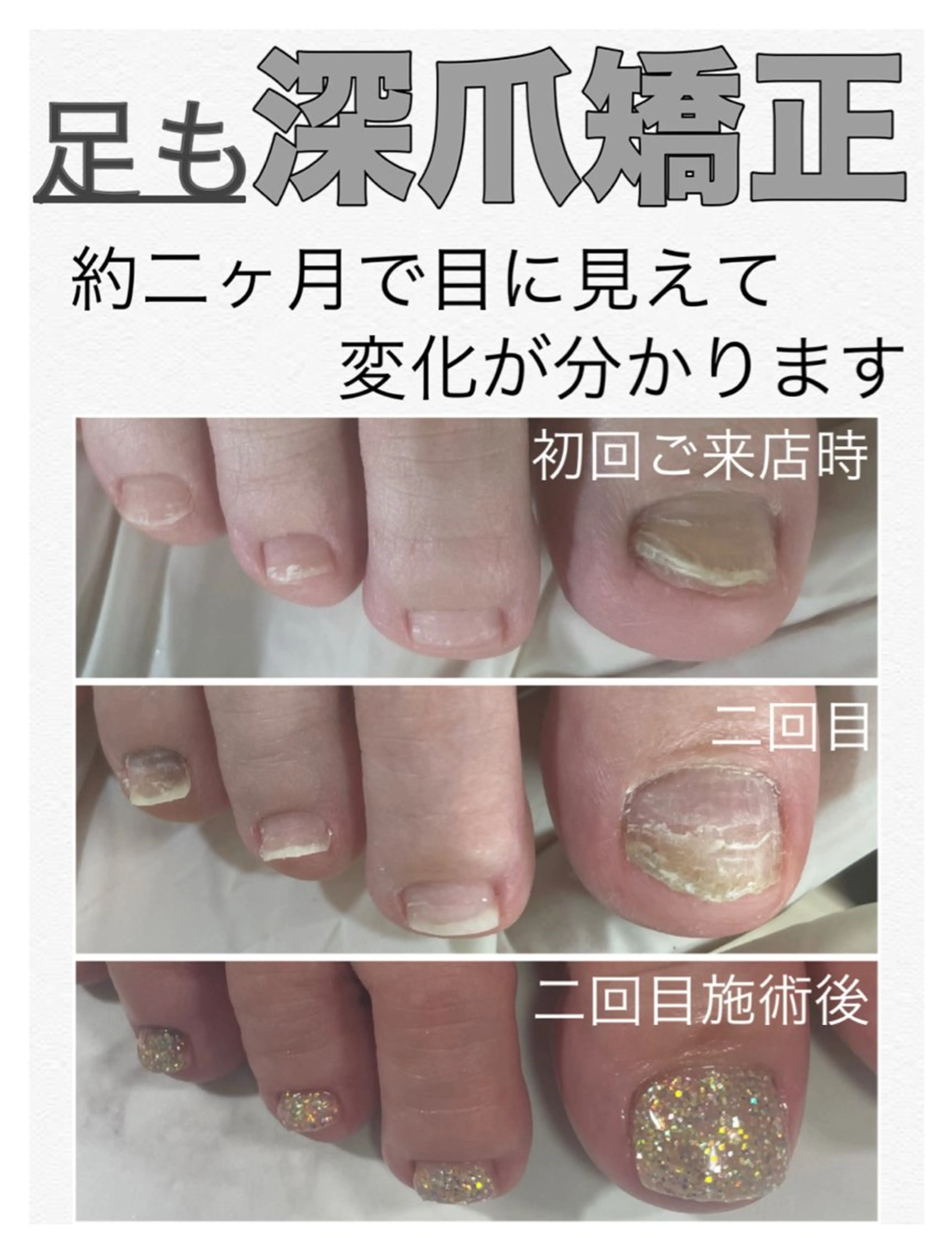 フット深爪矯正【長さ出し】◆ラメ◆(オフ込/フットバス付) むしったり 割れたり 小さくなった爪も綺麗な状態に✧︎の写真