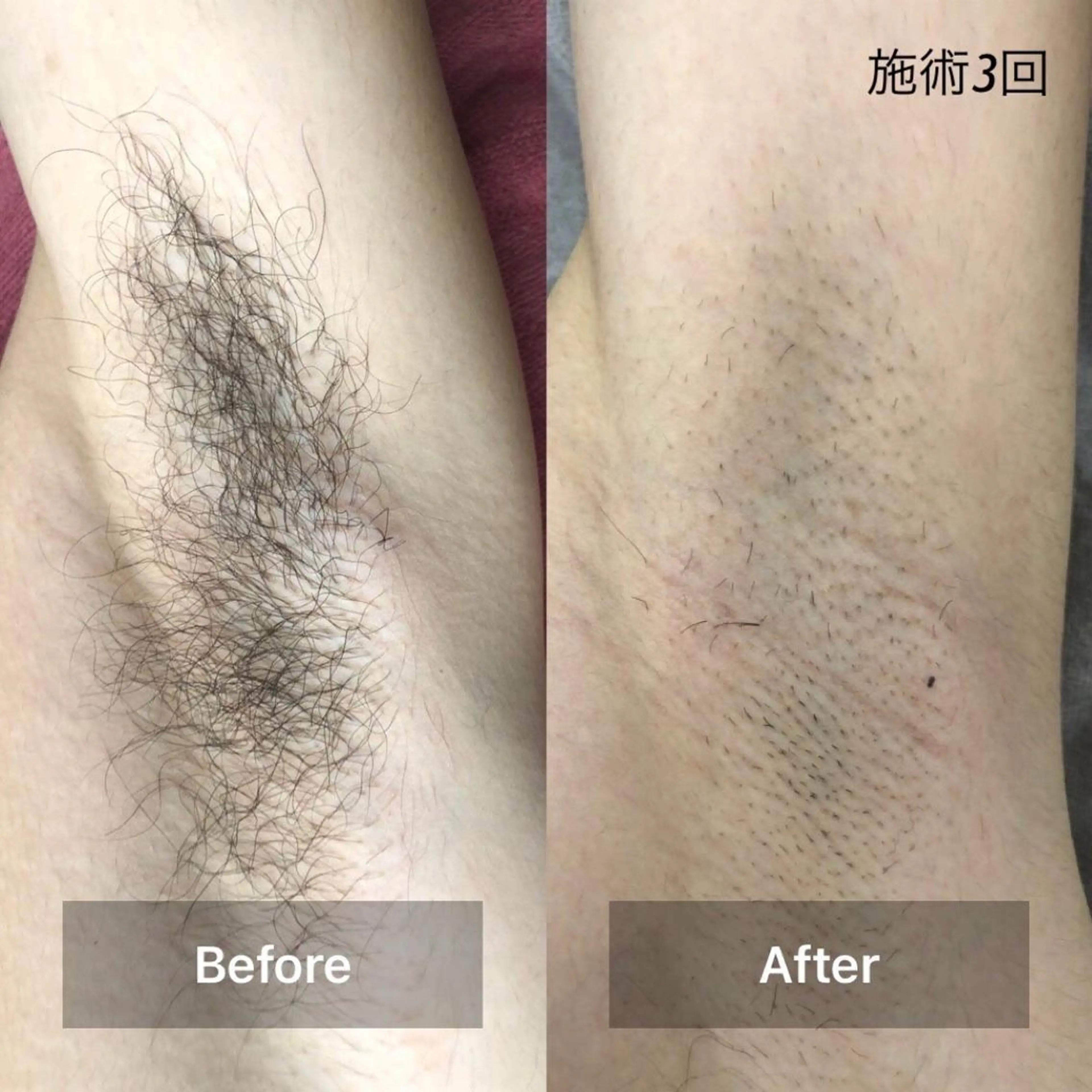 【メンズ】ワキ脱毛 ♪保湿ケア付♪の写真