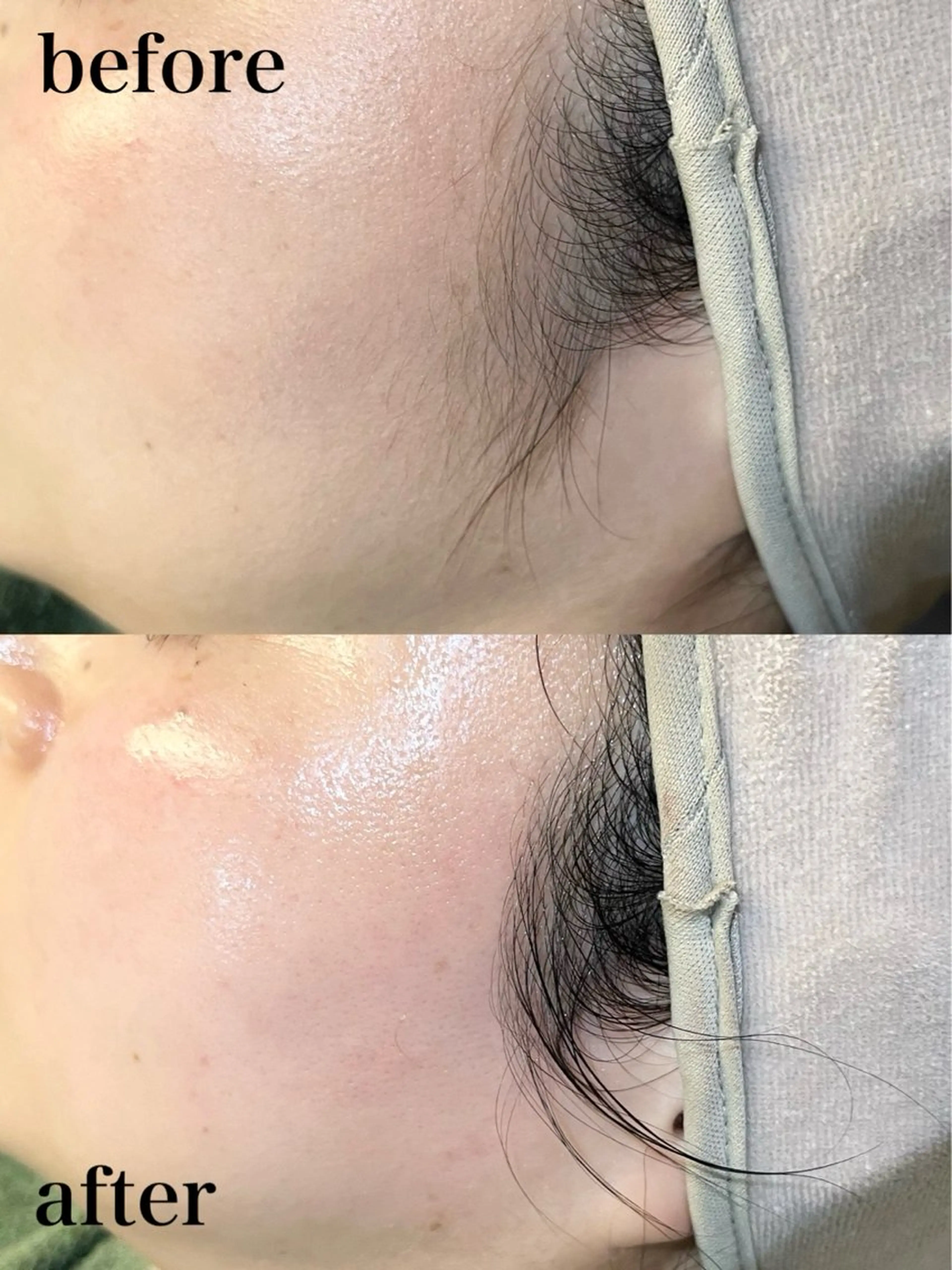 フェイシャルワックス（顔脱毛）（産毛脱毛）の写真