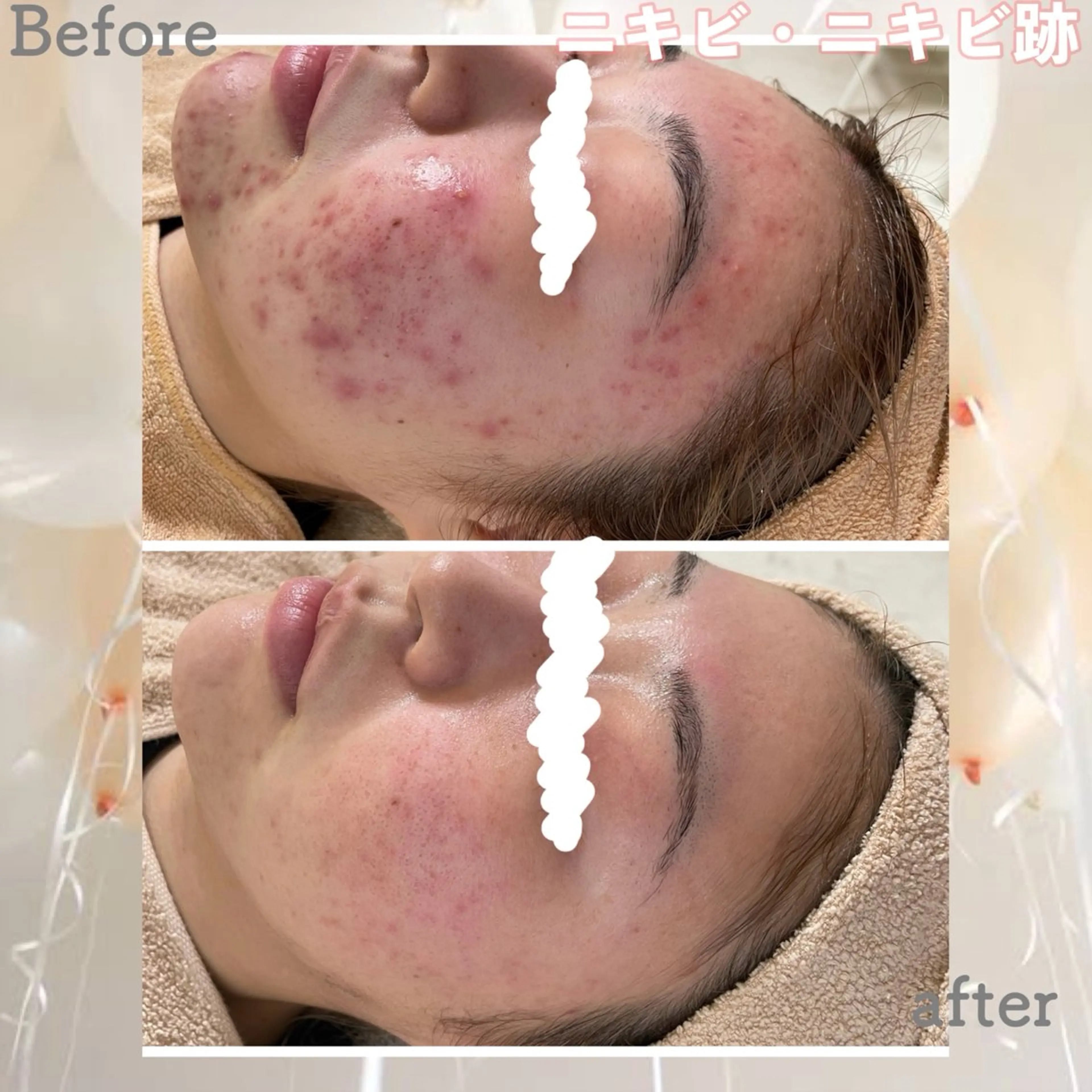 エステ ニキビ&跡改善サロン オーナー光木のエステ・リラクイメージ