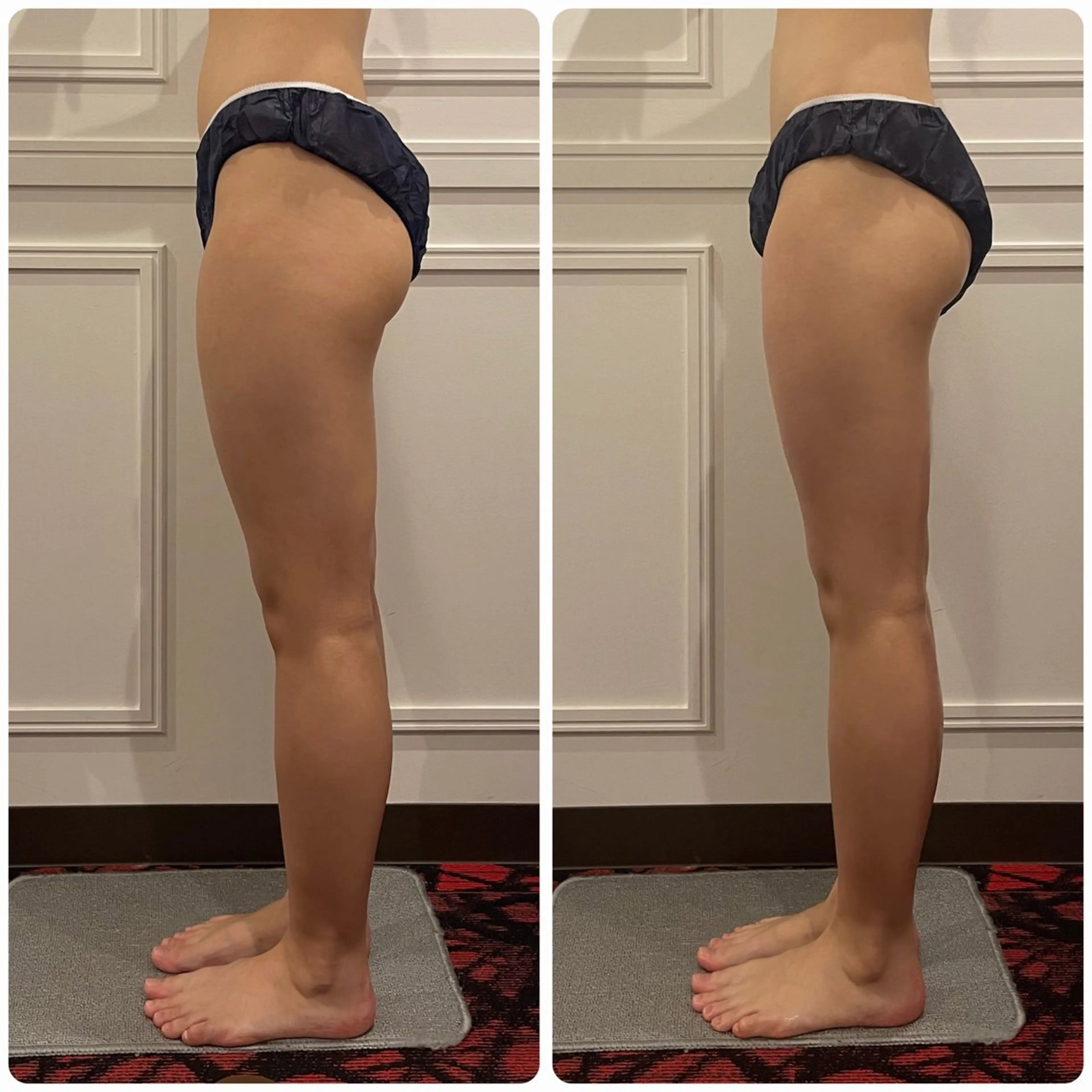 気になる脚に徹底アプローチ🔥ハイパーナイフEXとハイパーシェイプの最強の合わせ技★むくみ解消＆セルライト＆ヒップUPの写真