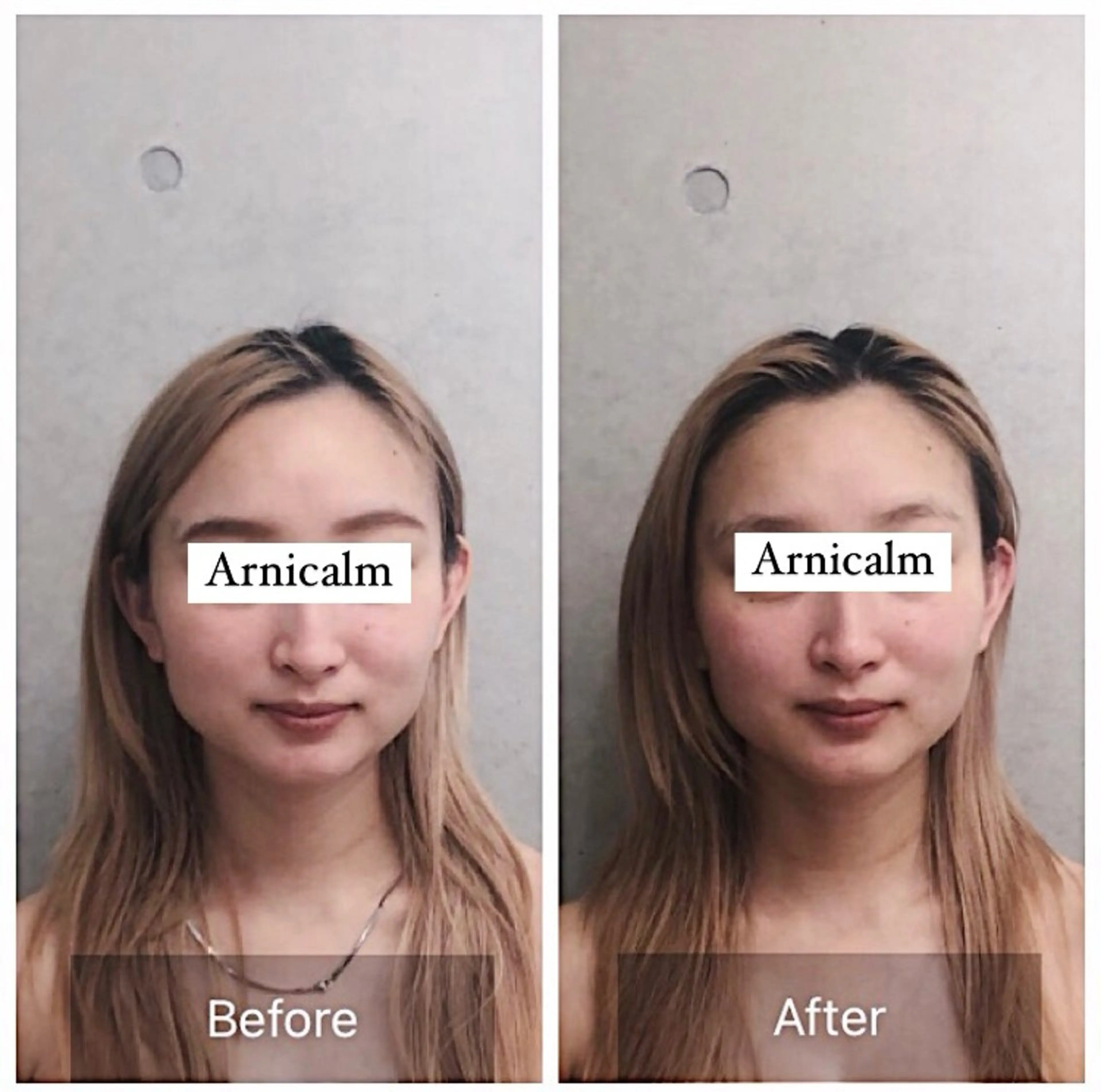 エステ ハーブピーリング 肌再生ピーリング/のエステ・リラクイメージ