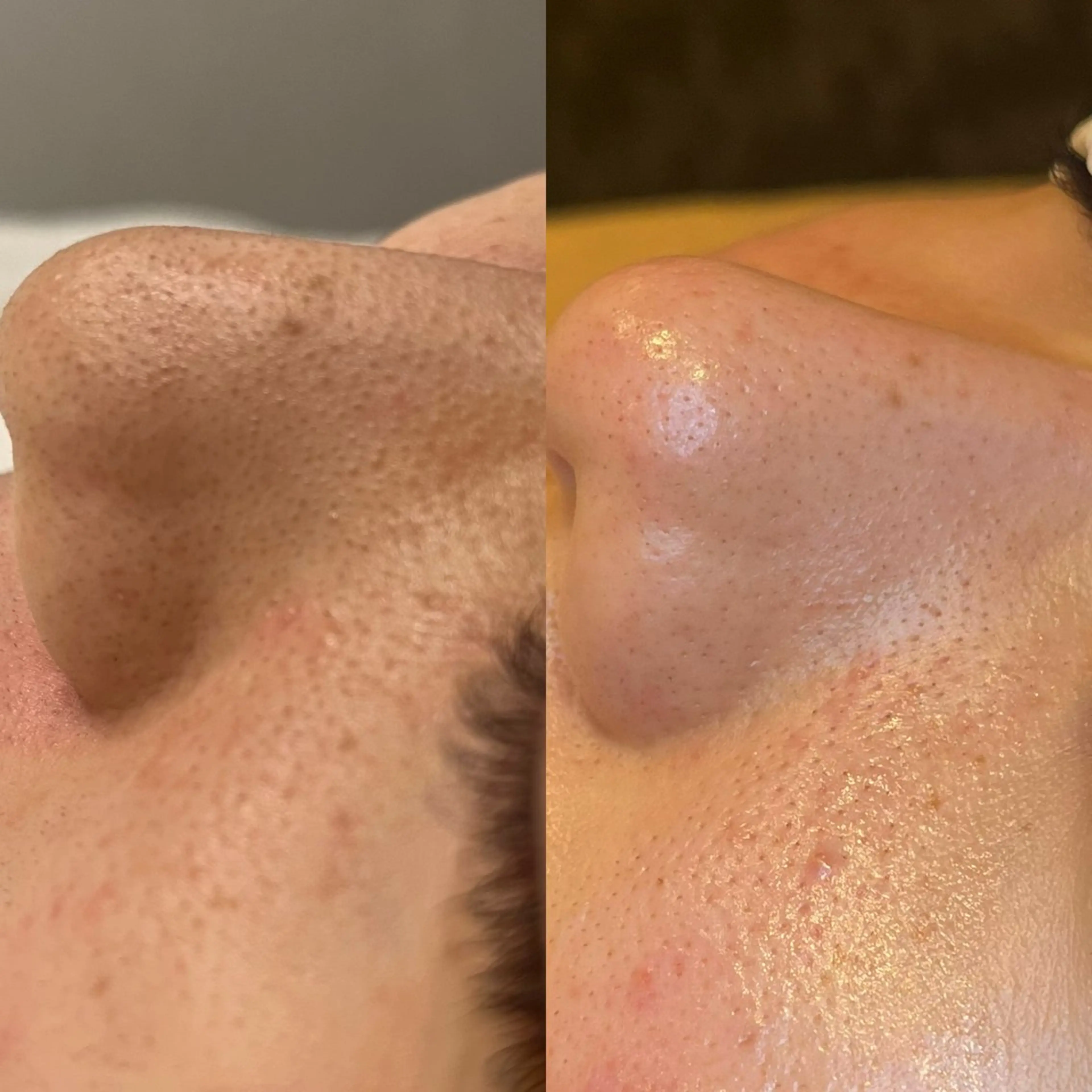 【頑固な毛穴の黒ずみ】徹底的に黒ずみ撃退！毛穴引き締めマスク13200→8800の写真