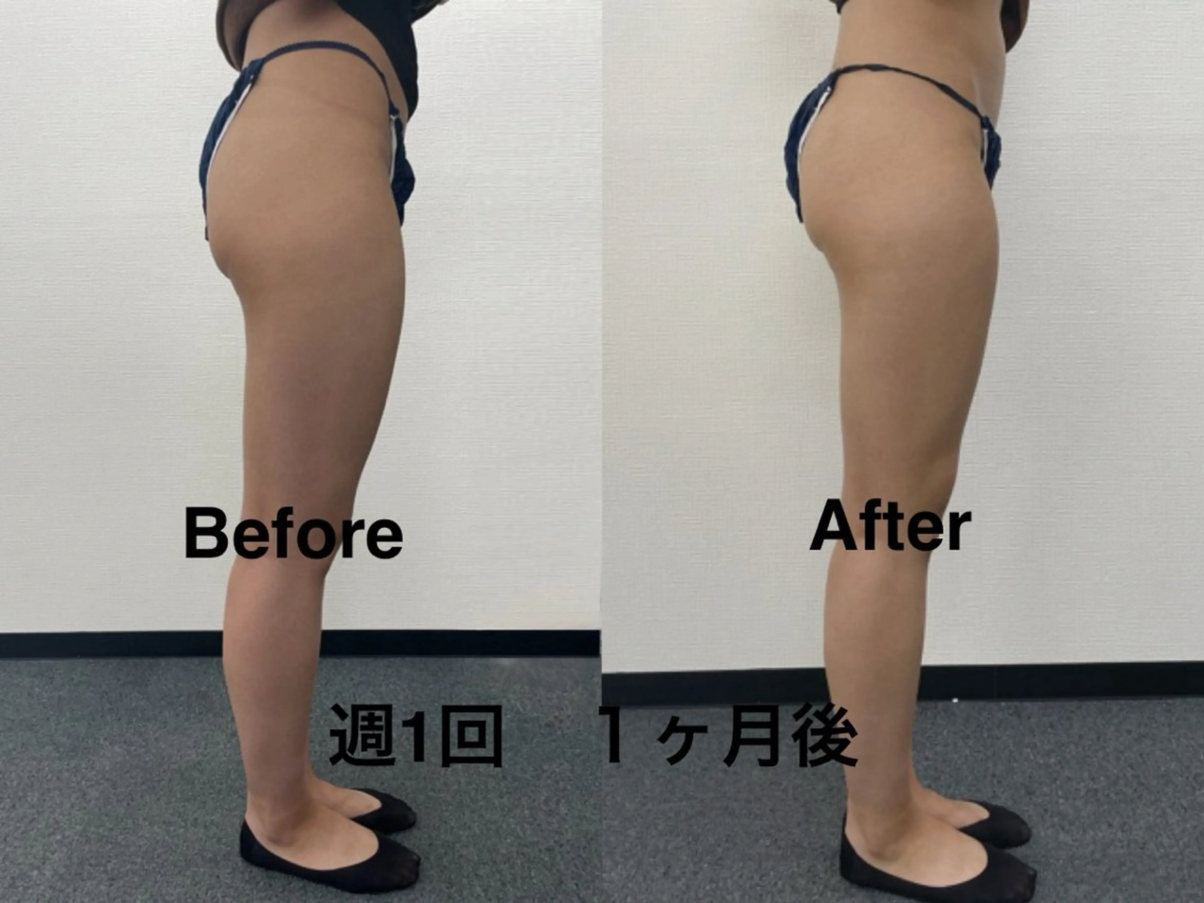 引き締まった美脚&美尻に！最新高周波winbackで下半身ケア　90分の写真