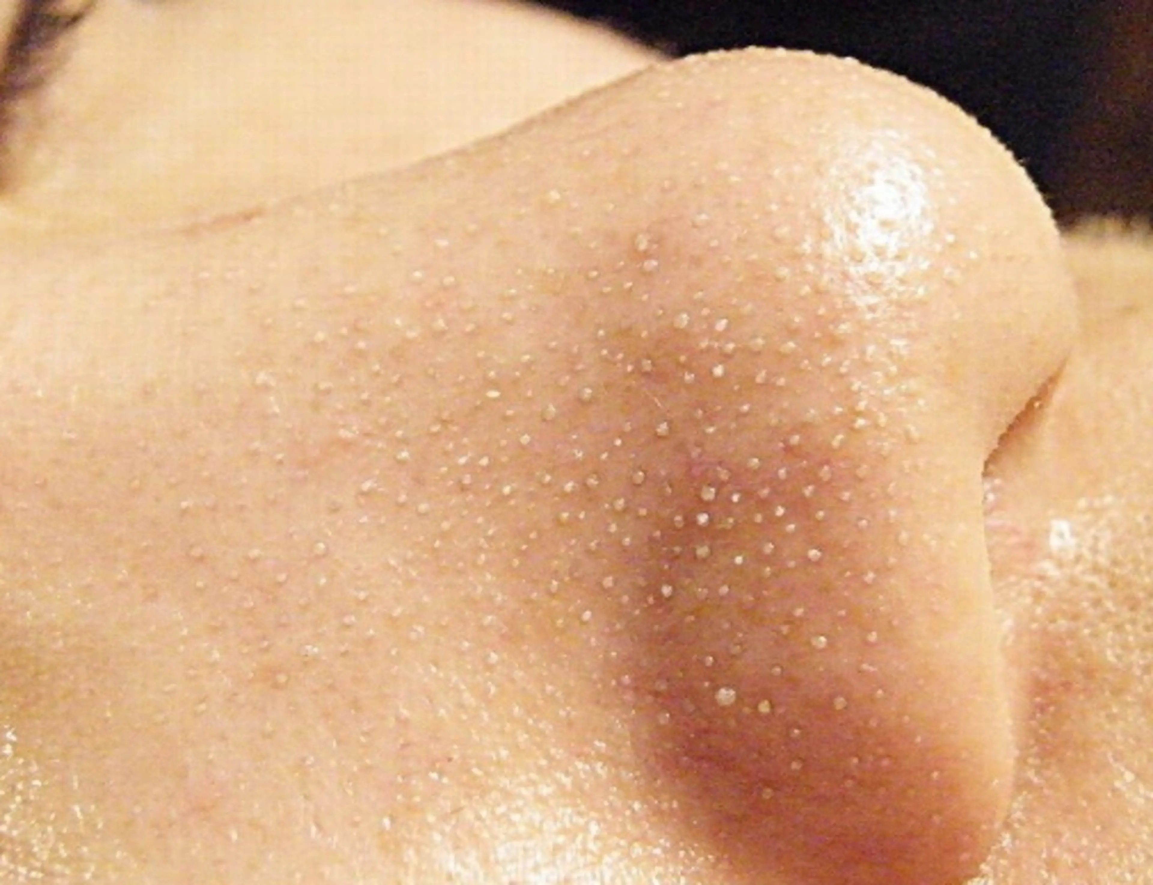 ＜人気No.1★）【小鼻のブツブツ解消！】毛穴レスフェイシャル¥ 3300の写真