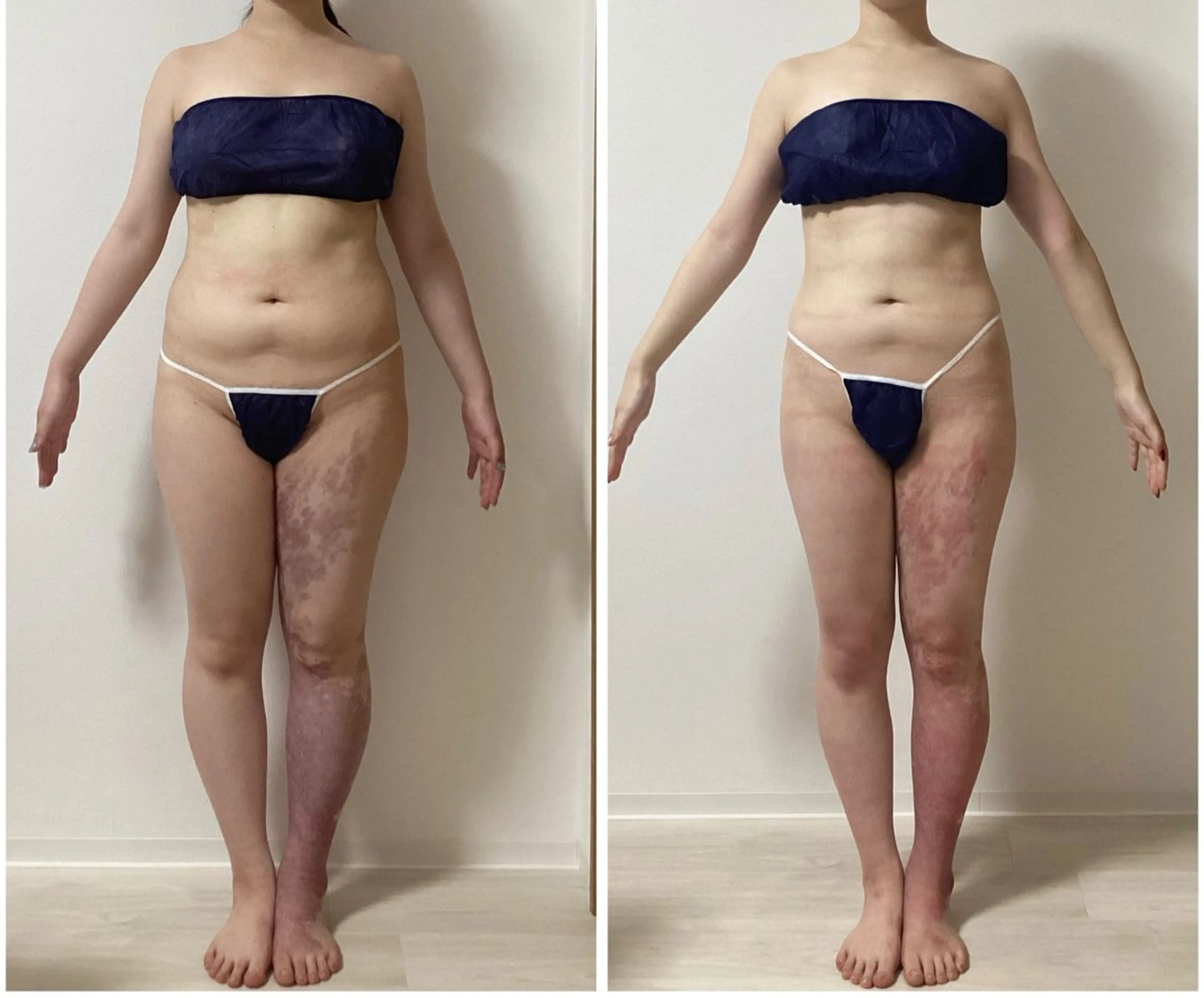 エステ ハイパーナイフ痩身 Misakiのエステ・リラクイメージ