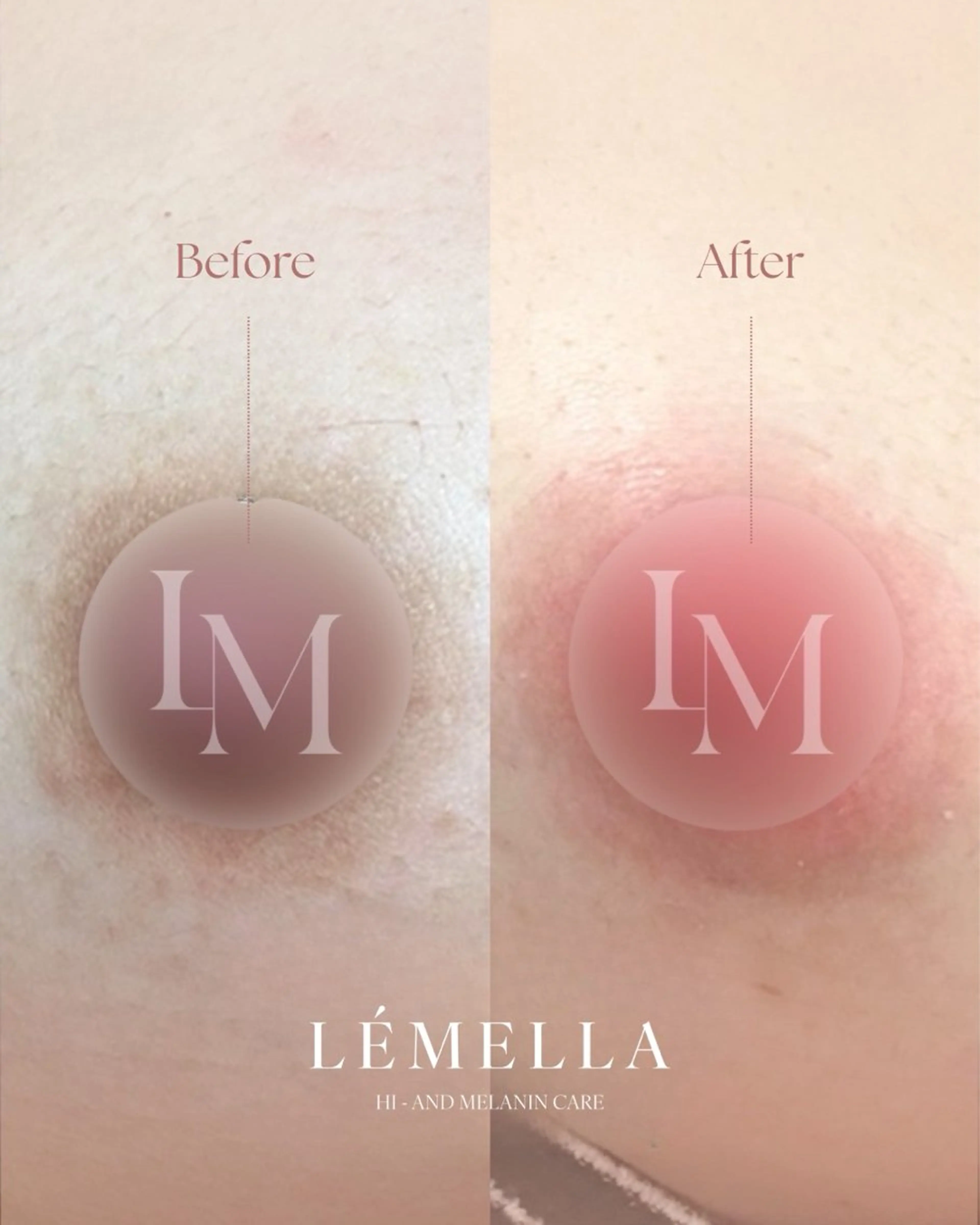 ルメラ　乳輪　メラニンケア　韓国では当たり前に受けている施術♪の写真