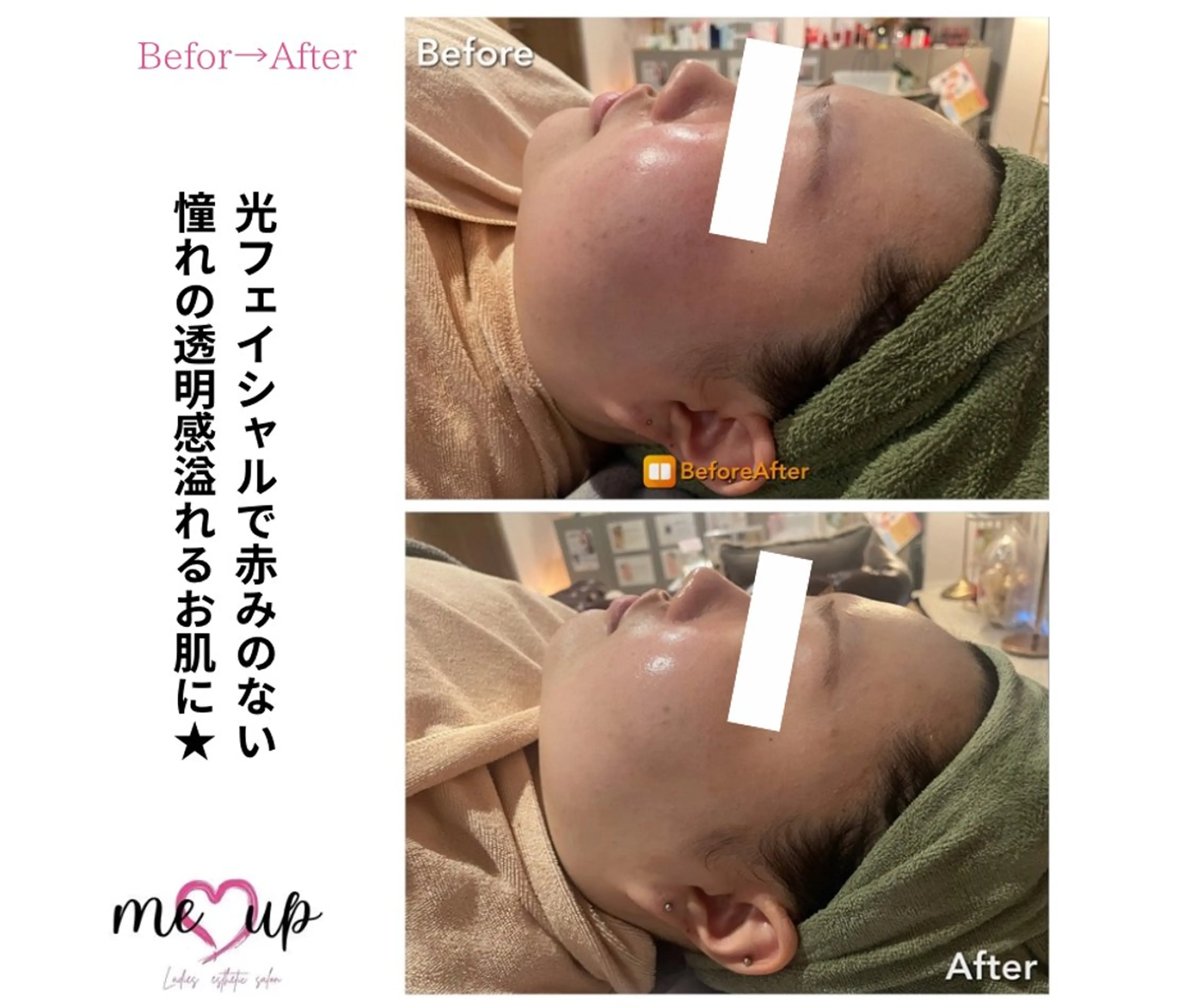 エステ Meupニキビ専門店 背中/ハーブ/肌管理のその他イメージ