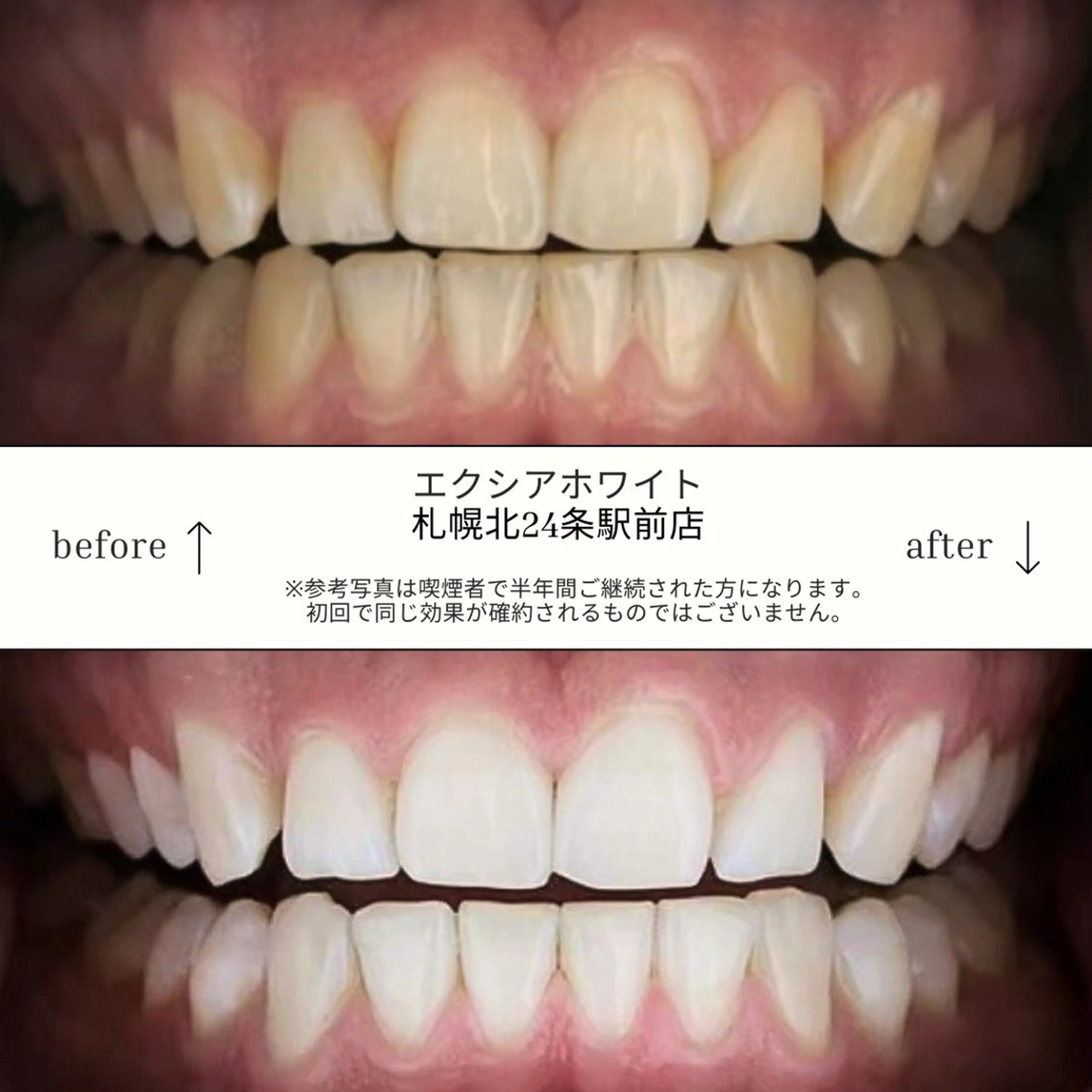 【定額★通い放題】セルフホワイトニング ¥11,000/月の写真