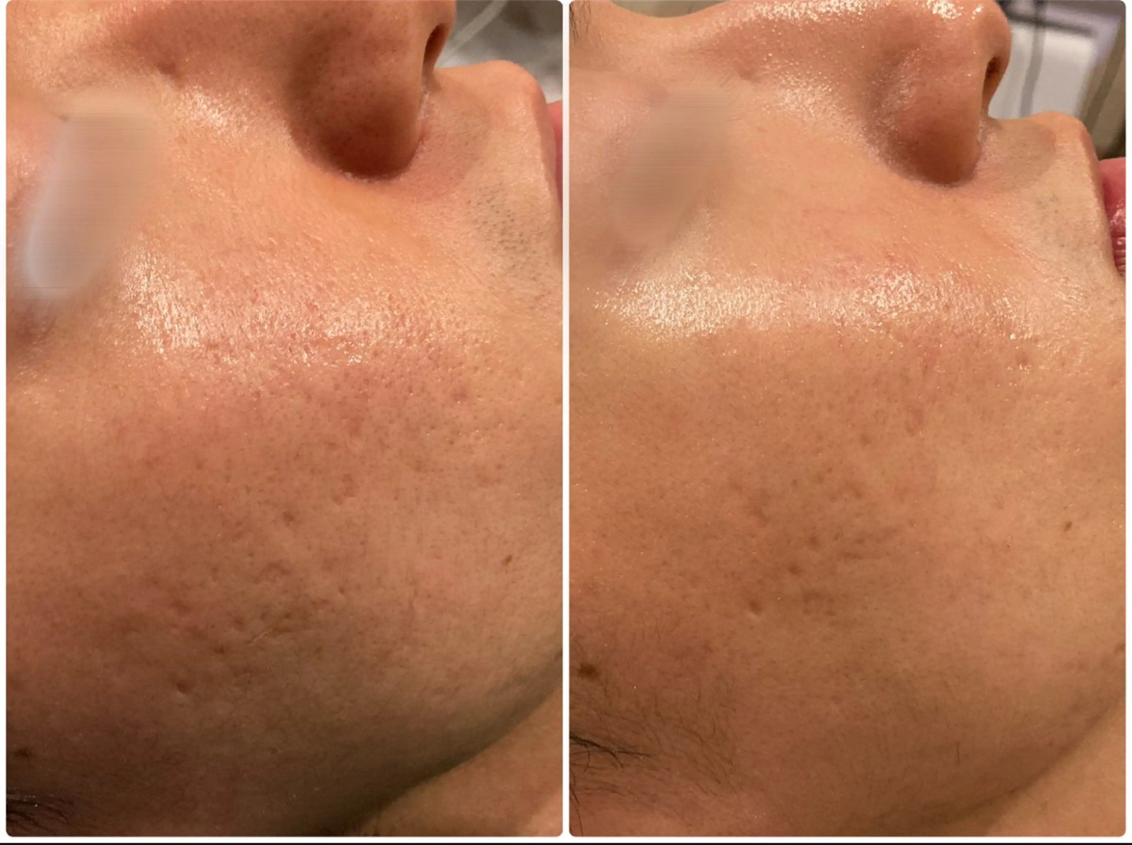 第4世代ピーリング【ララピール】✖️【アクアダーマ ニキビケア】集中ニキビケア💎の写真