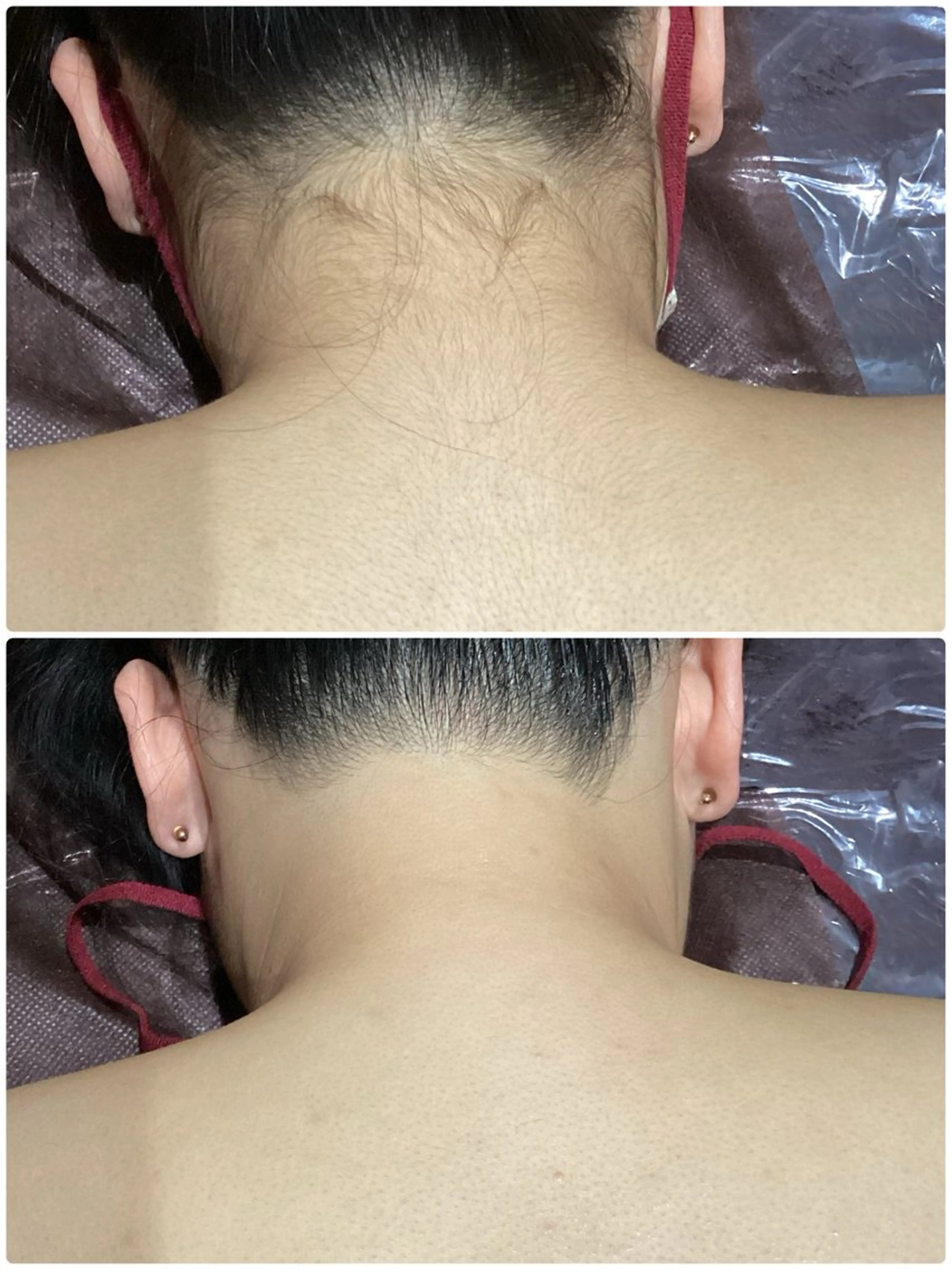 期間限定✨全身（vio込み）➕顔¥15000❣️ご来店前の自己処理不要🫡💕うなじ、手足の甲指も付いてます💗の写真