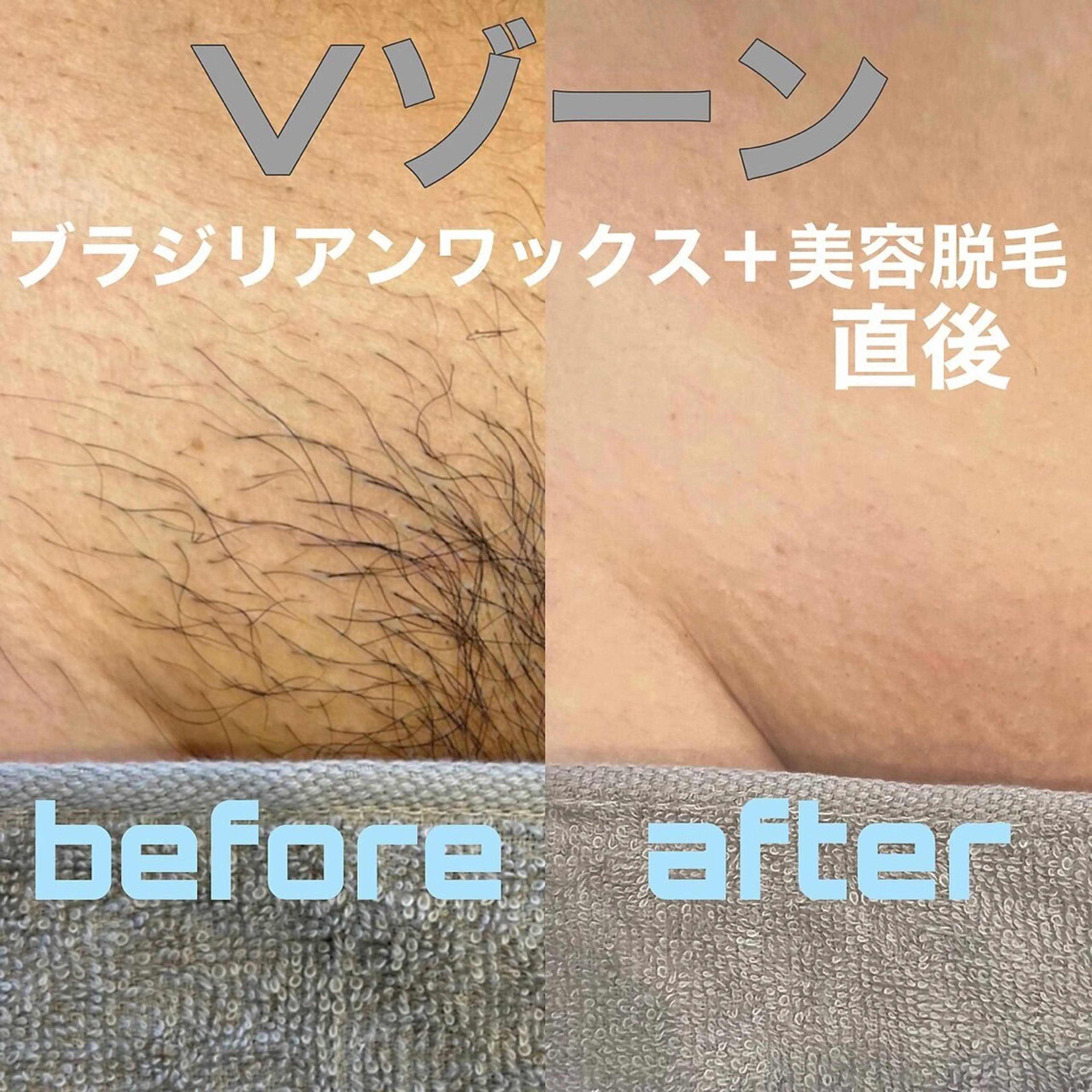 【MEN'S】VIOワックス×美容脱毛の写真