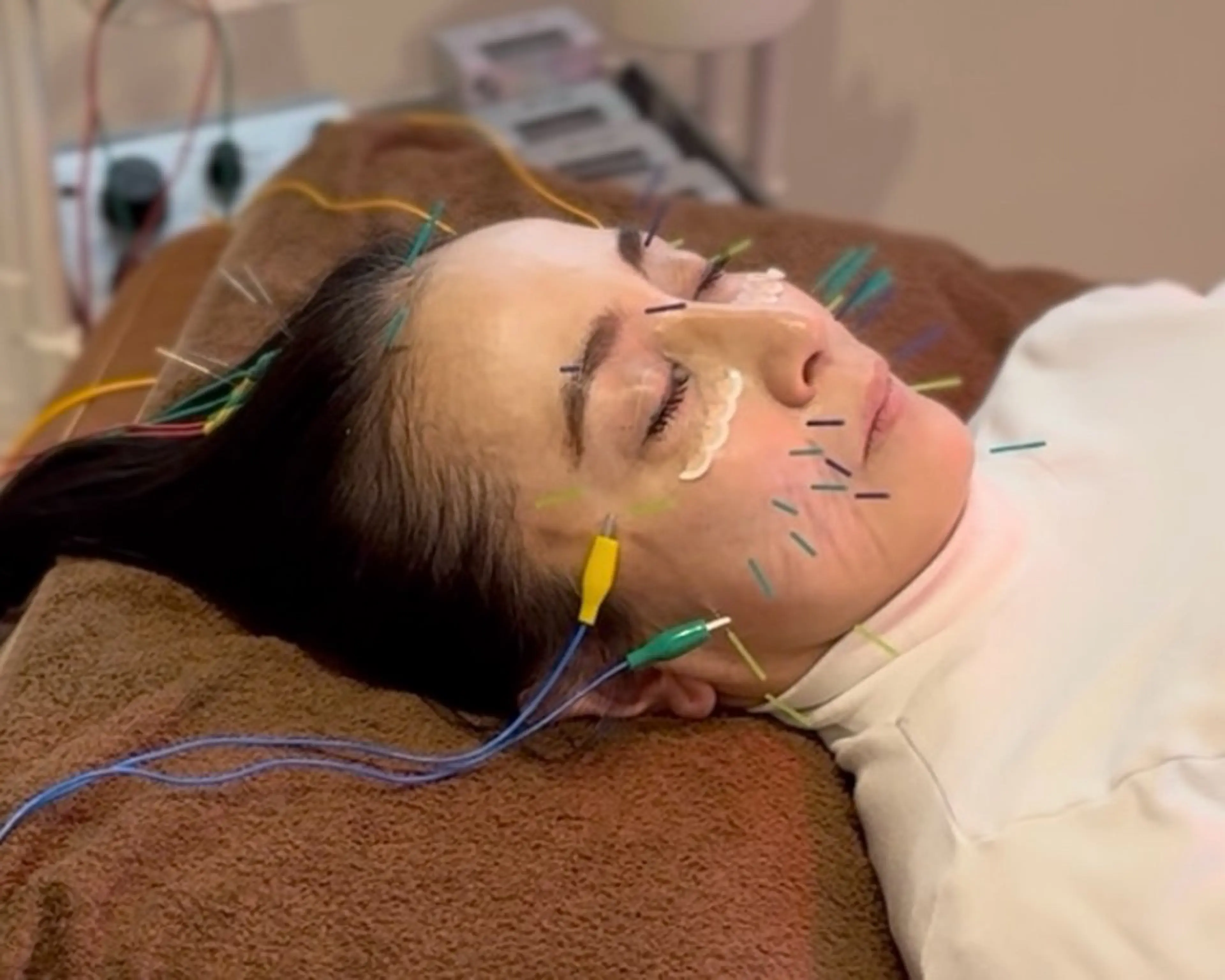 【40〜50代人気】大人の美容鍼60分|巡りケア付き【女性専用・浦和】の写真