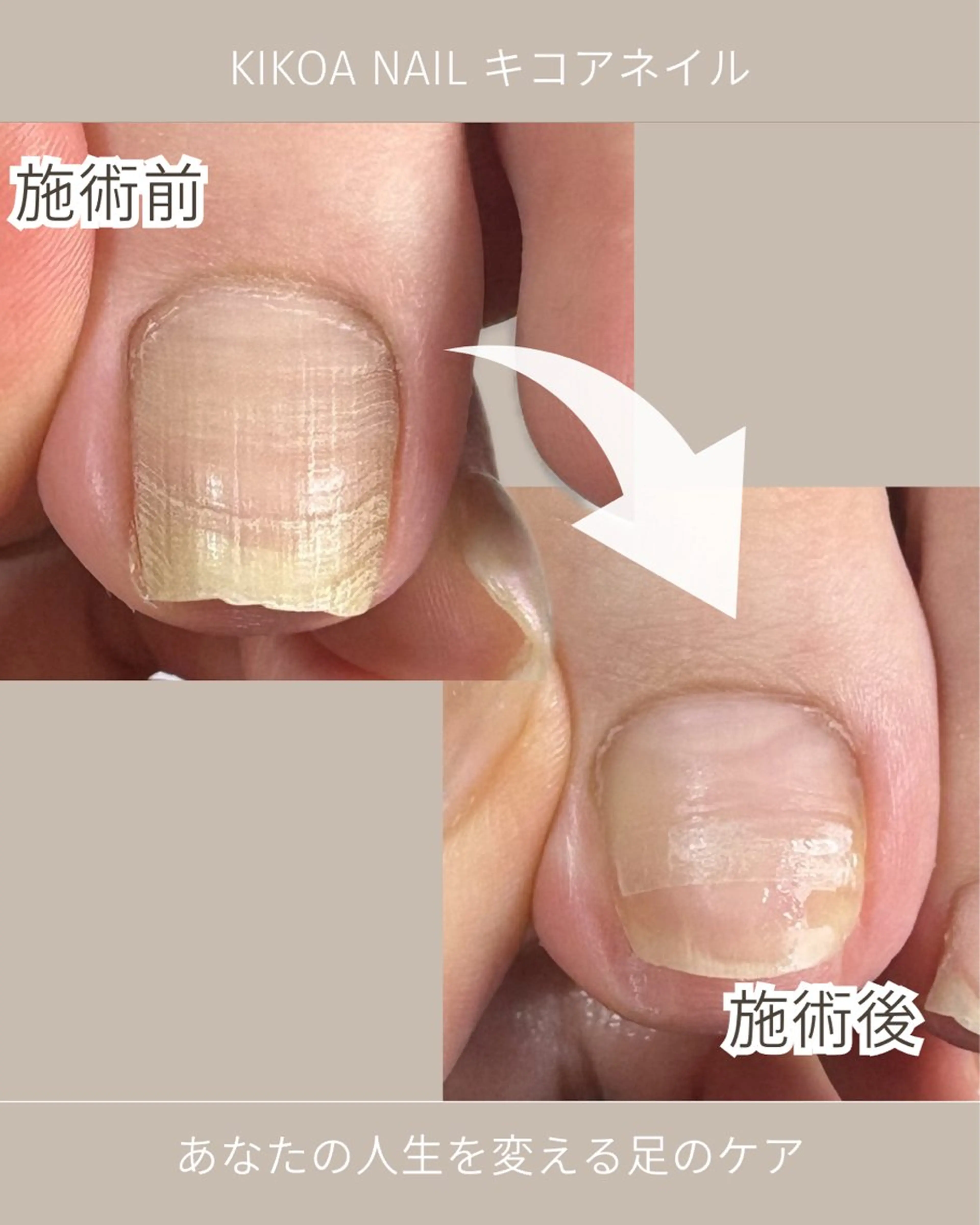 ネイル フットネイル KIKOA NAIL キコアネイルのネイルデザイン