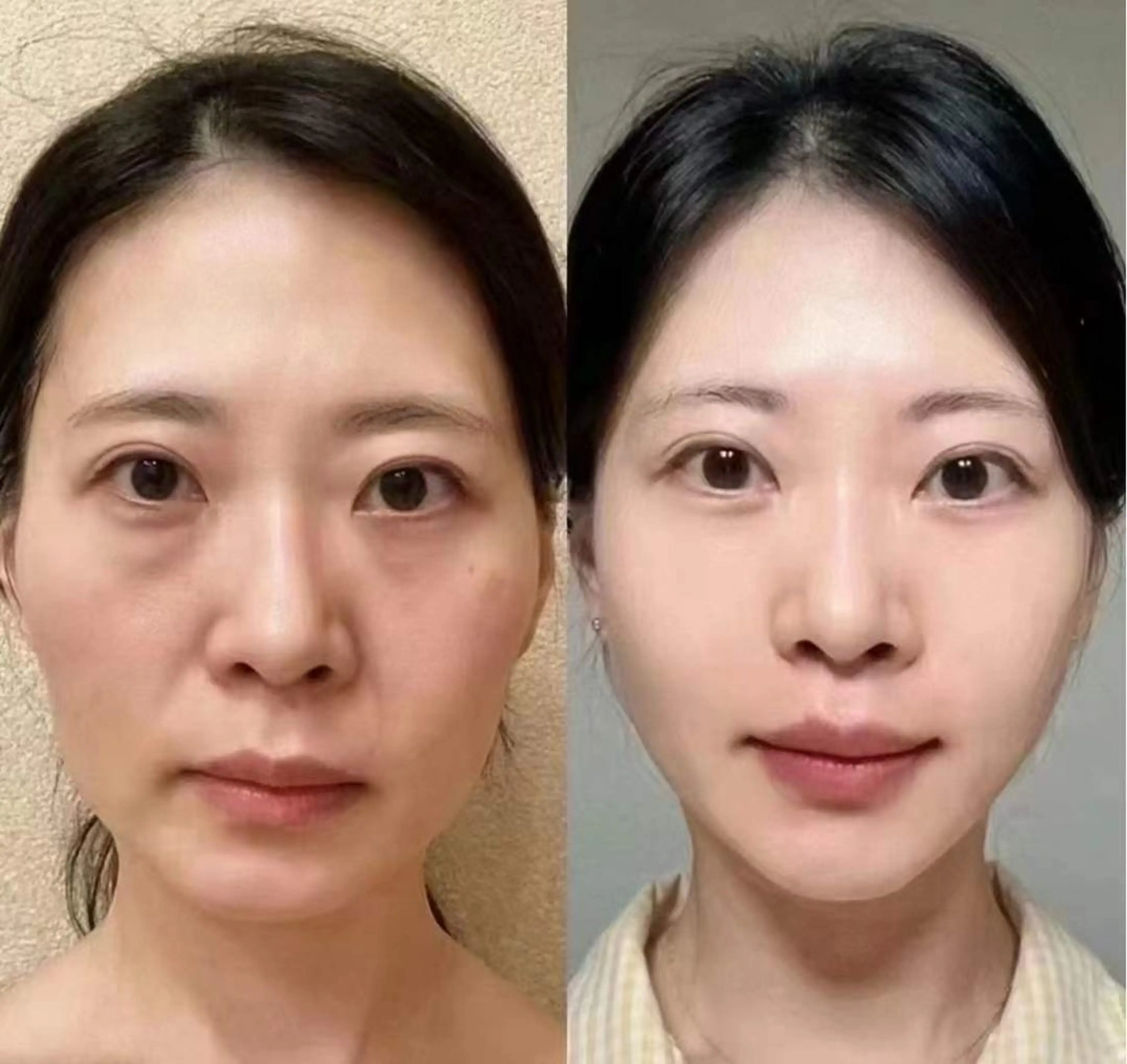 ネイル ブライダルネイル ホワイト エステ aliaハイフ&水光ジェットサロン所属・aliaハーブ水光店 エステティシャン募集のエステ・リラクイメージ