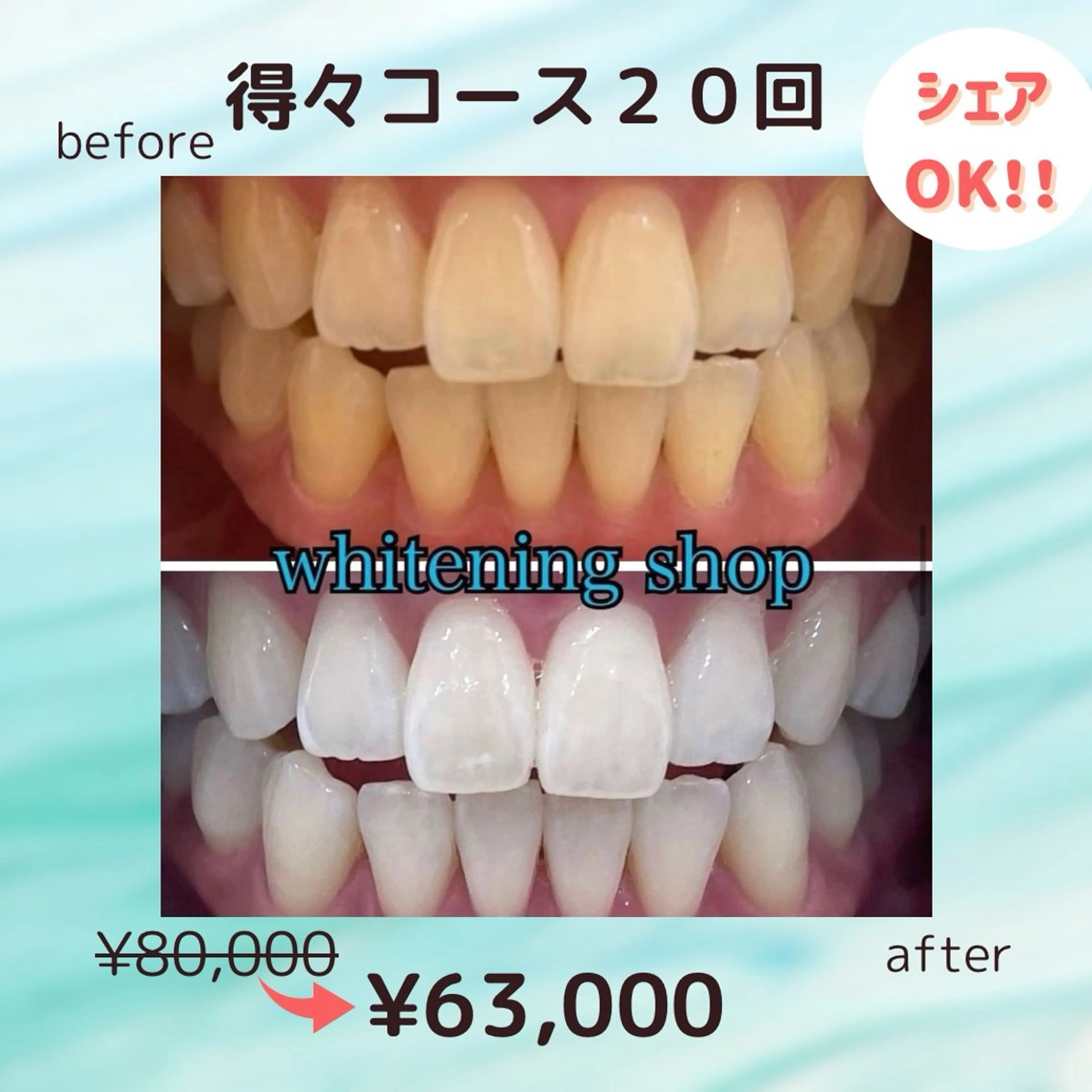 💎人気No. 2👑得々コース💎美白セルフホワイトニング💎20分x40回照射¥80,000→¥63,000の写真
