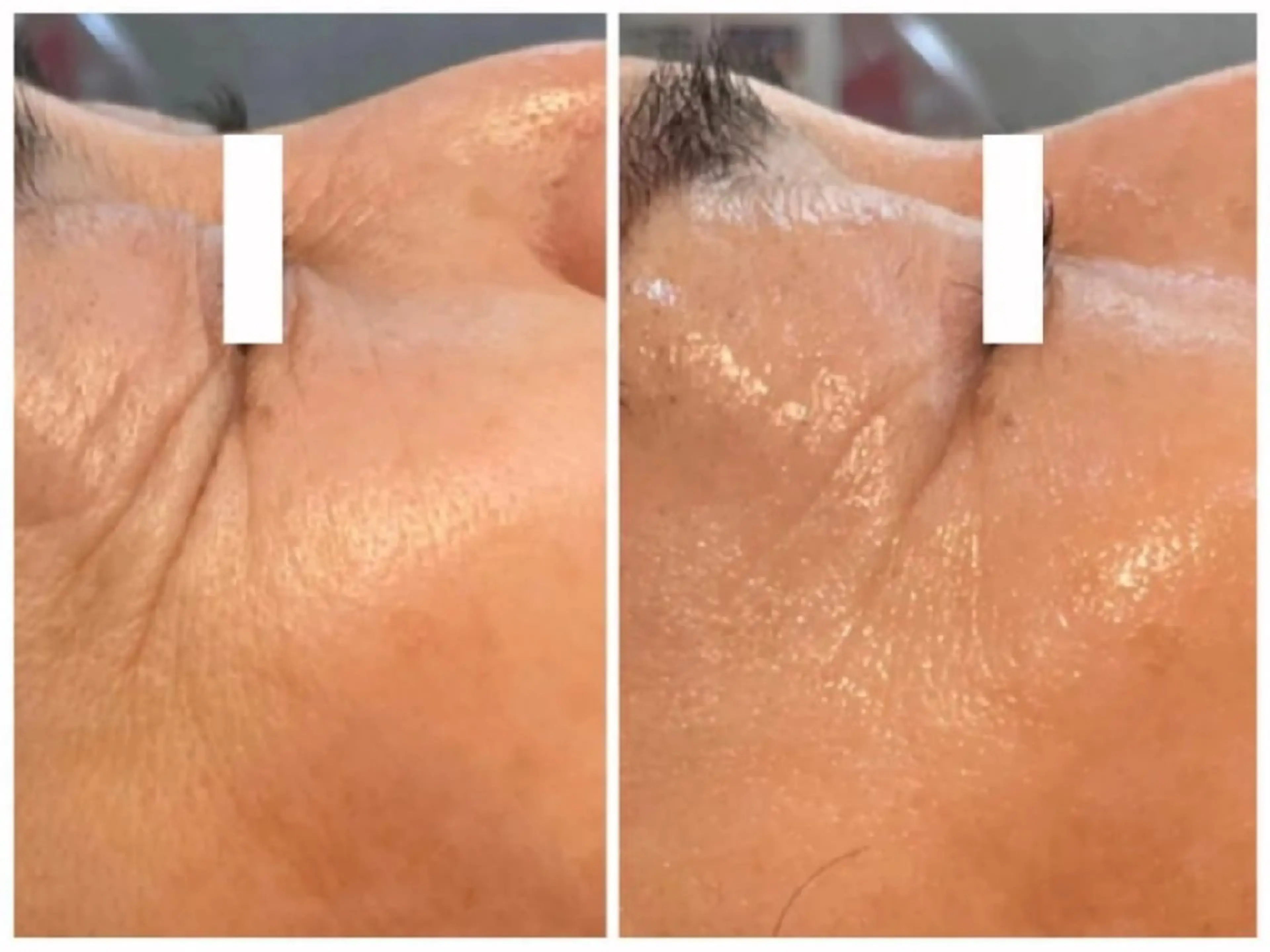 【-5才肌】小ジワ・くすみ・ハリ改善ケアの写真