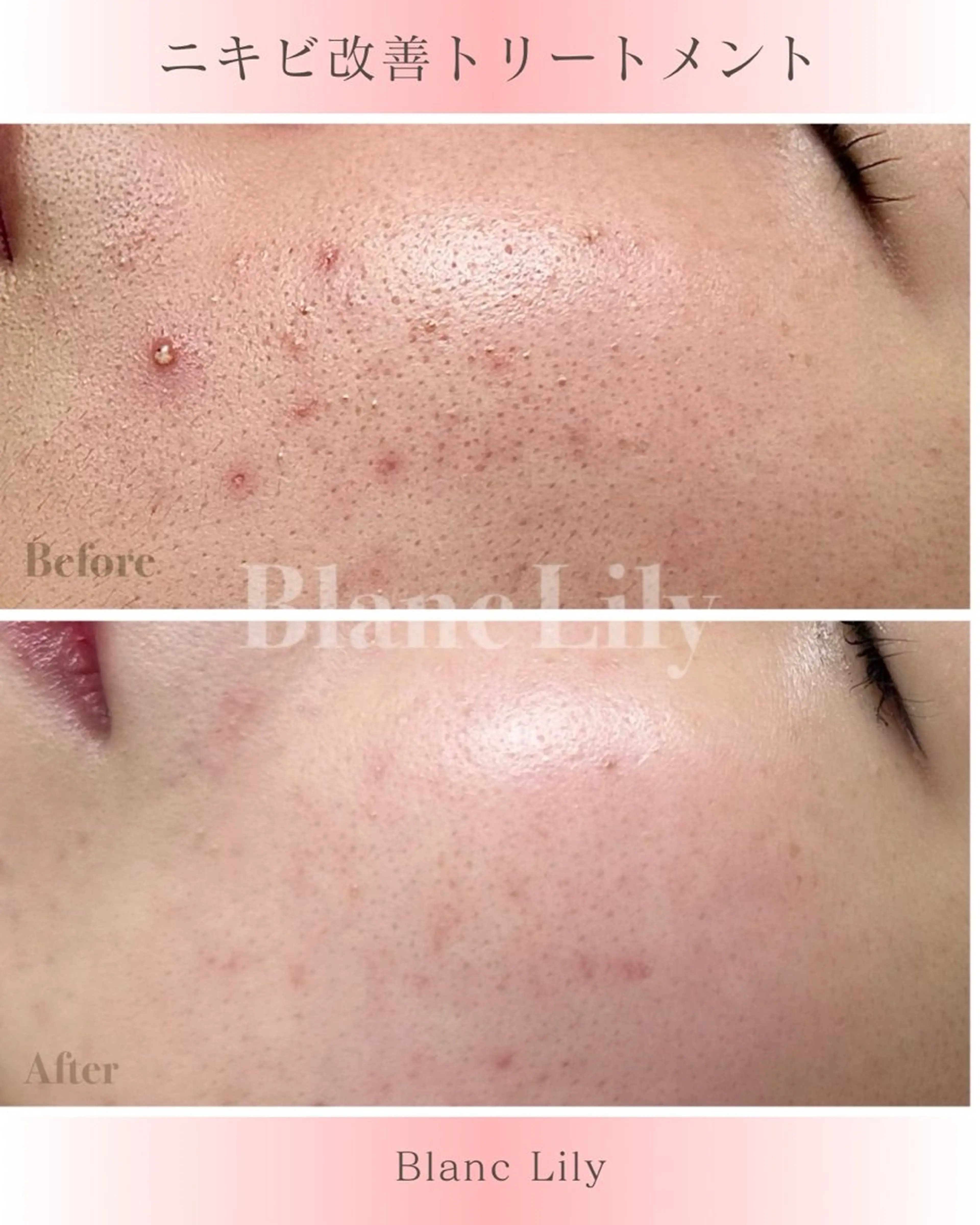 【ニキビケアトリートメント】★アクネピーリングの写真