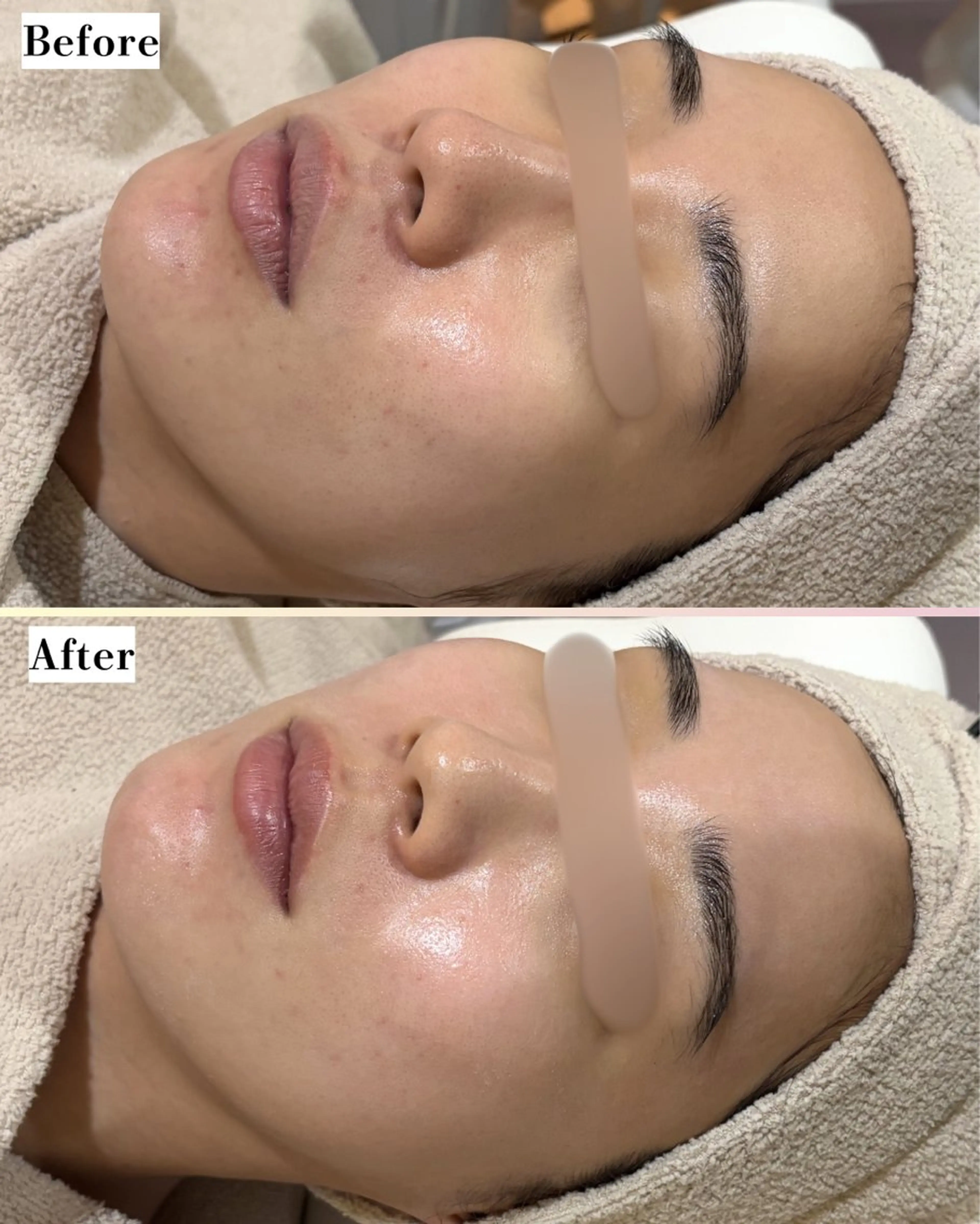 エステ |ピーリング・毛穴| soina神楽坂のエステ・リラクイメージ