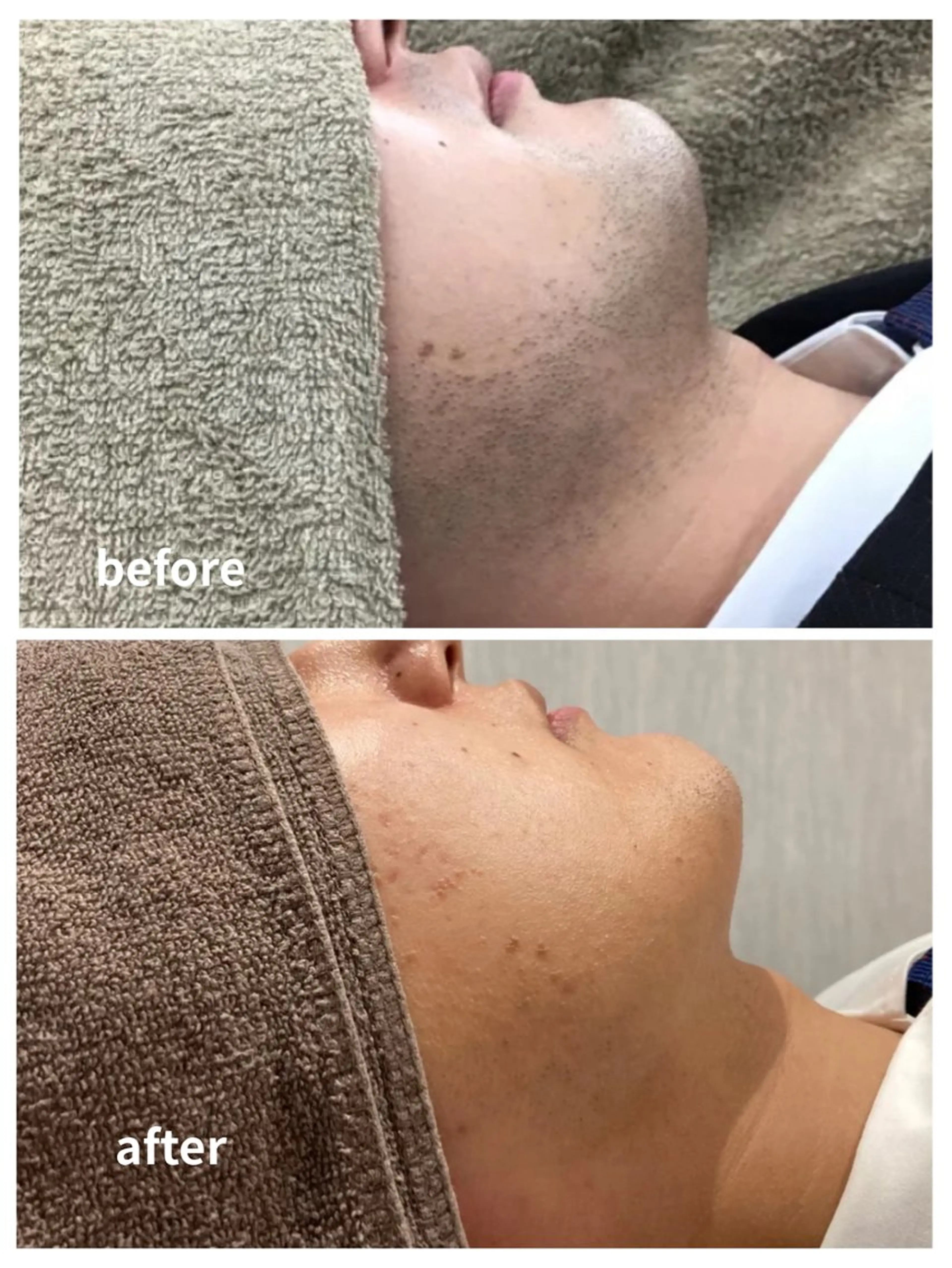 【青ヒゲ改善】初回メンズ顔脱毛¥3000の写真