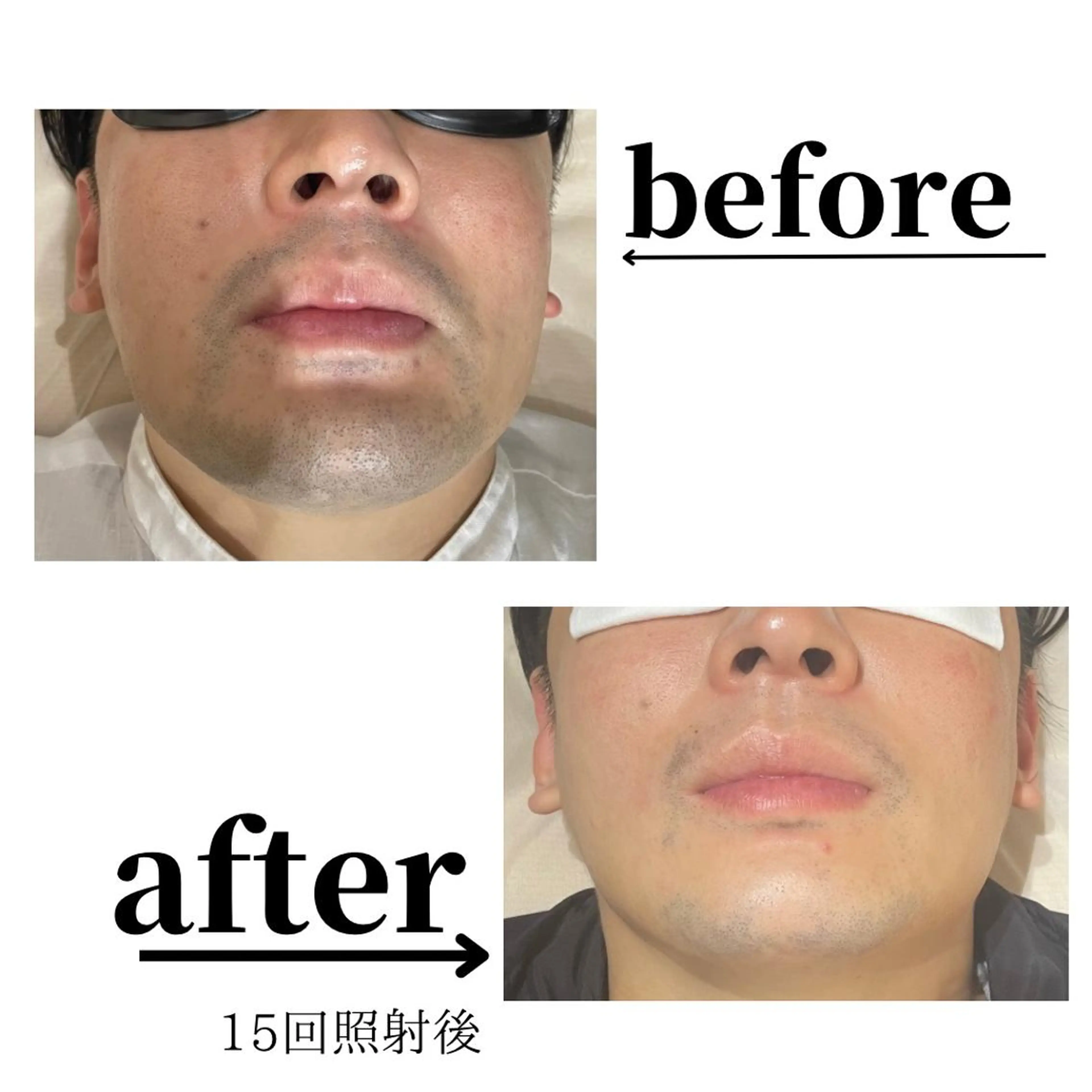 ●ミニモ限定【全顔〔美顔〕メンズ脱毛】◎¥3900の写真