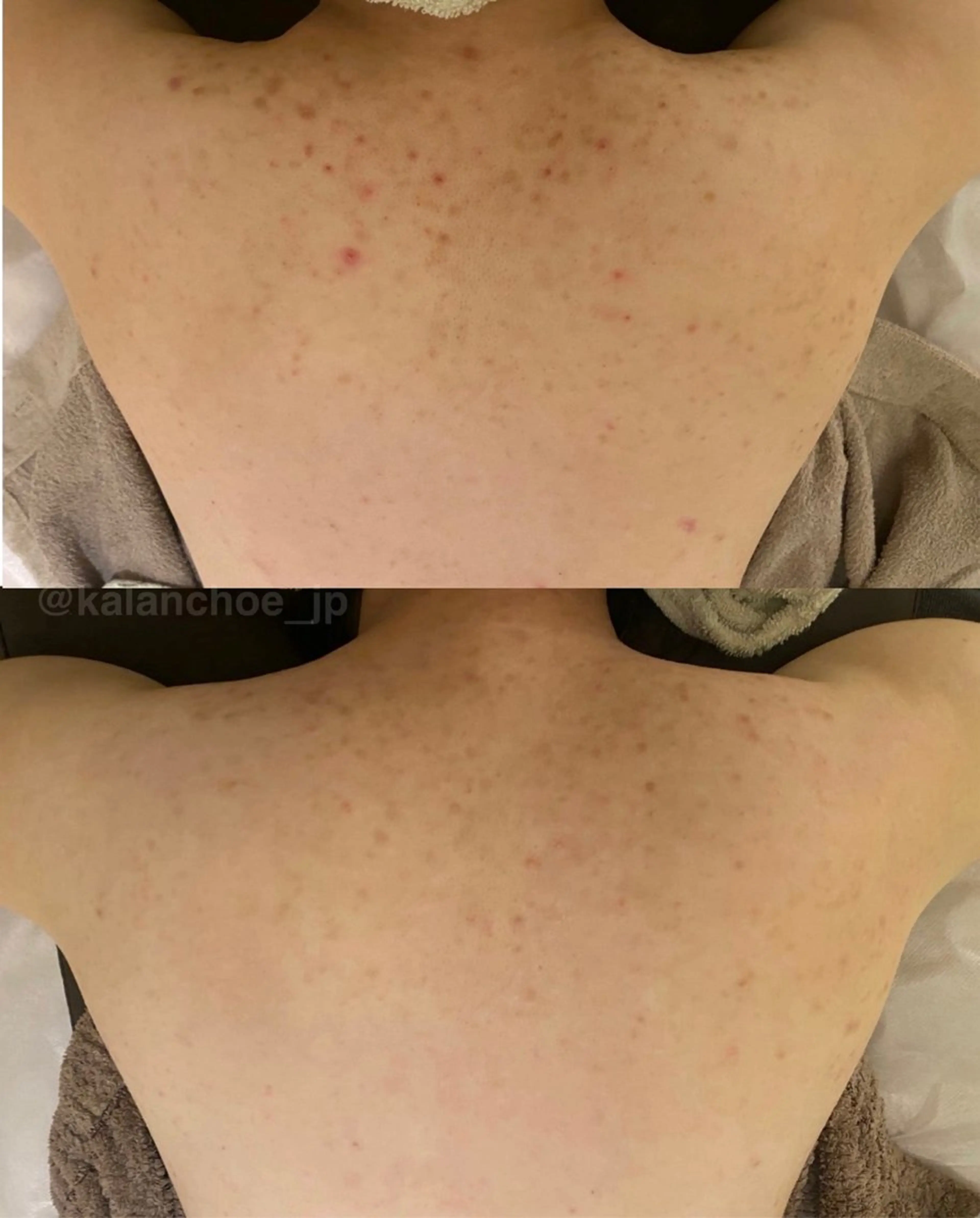 肌質改善 KALANCHOEのエステ・リラクイメージ