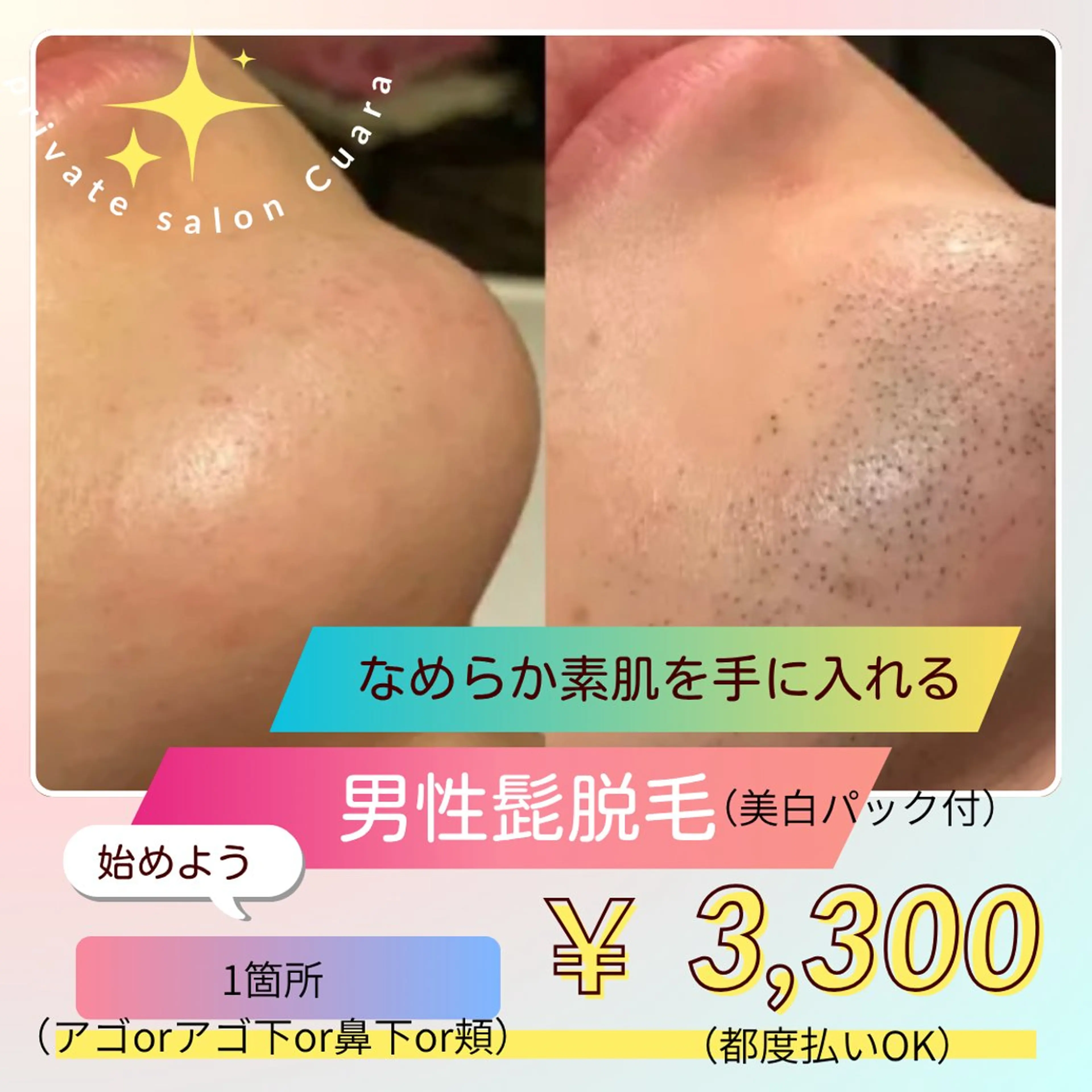 👨‍🦰男性髭脱毛👨‍🦰【一箇所】アゴorアゴ下or鼻下or頬からお選び下さい♪の写真