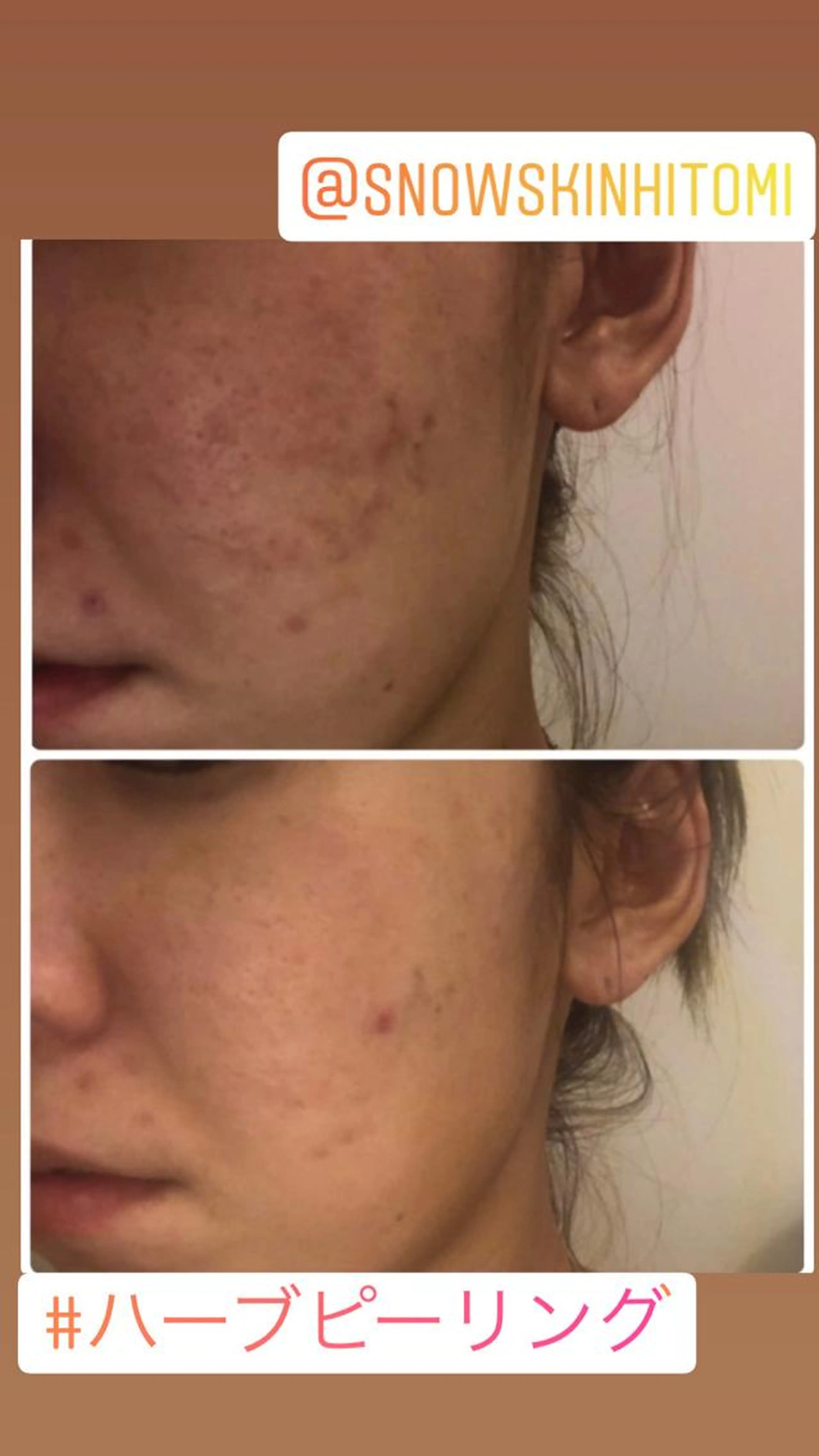 【周年感謝祭★先着10名】肌生成ピーリング★古い角質を除去し、厚くなった角質を薄くし、肌再生を促します♪ 30分　ニキビの写真