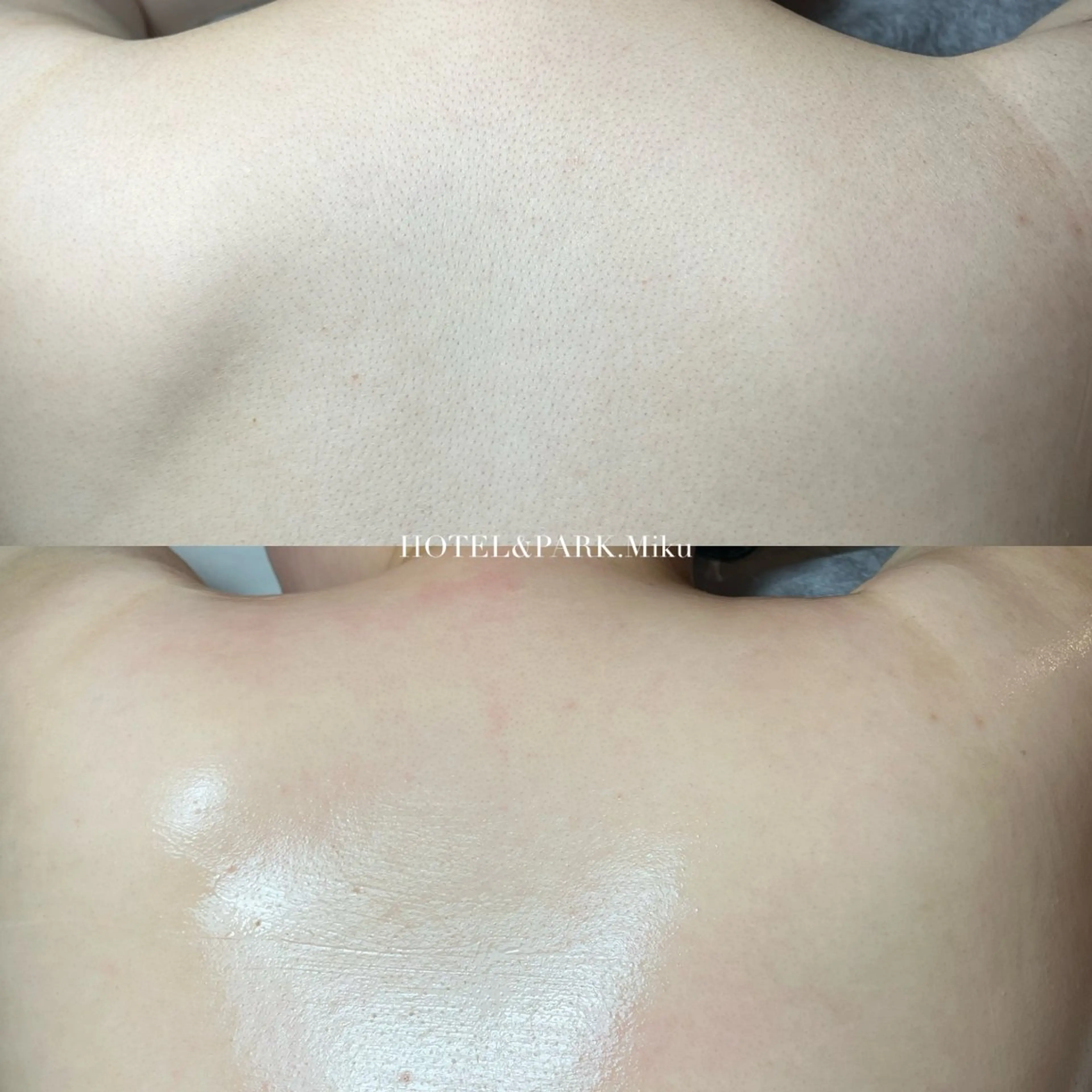 ミニモ学割🎓【背中上(うなじ込)ワックス脱毛】*鎮静パック付の写真