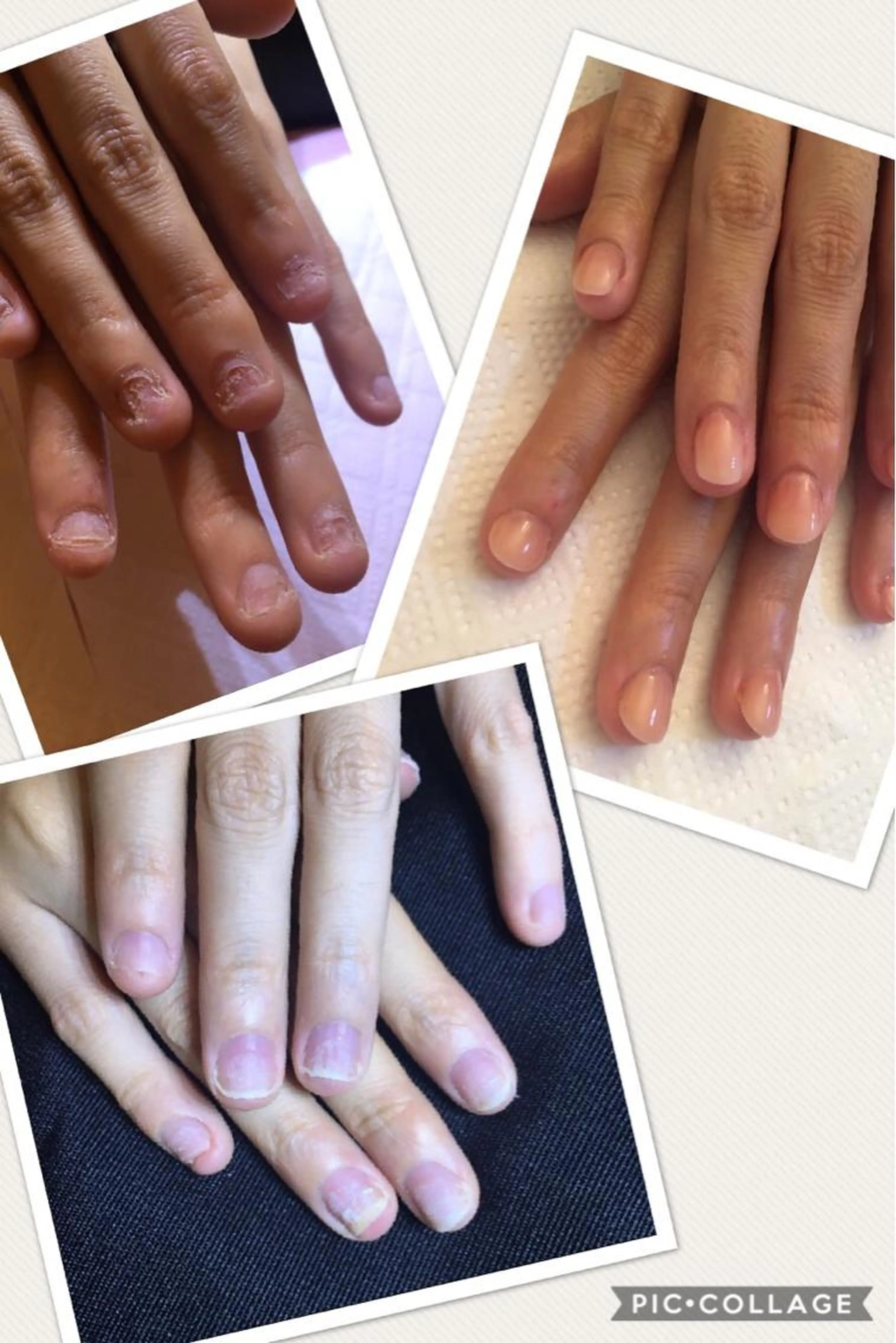 美爪へ変身❗️深爪矯正ネイル（ジェルコート込み）他店オフ込みの場合¥8800の写真