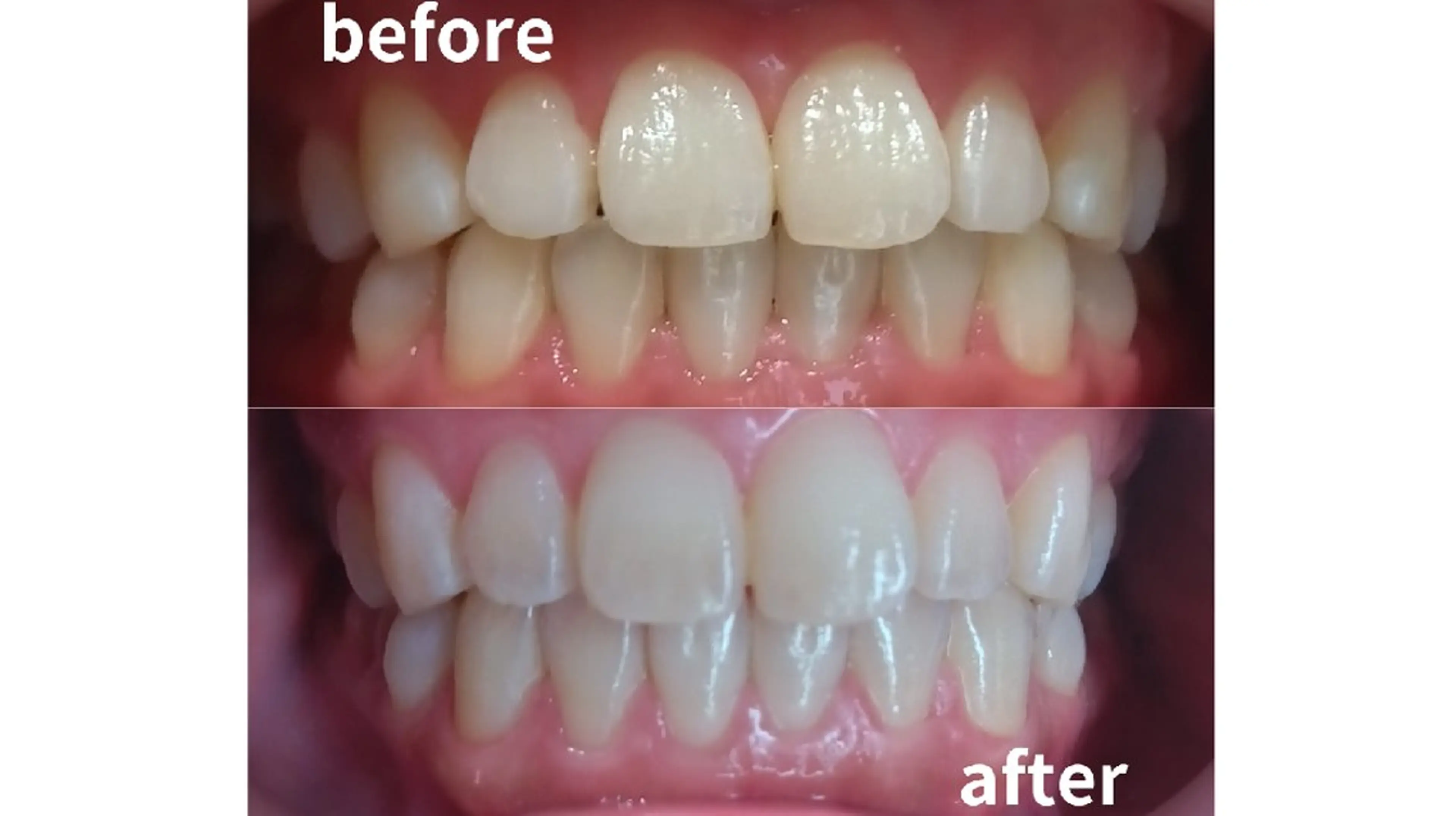 【当日予約OK!】30分で白い歯!初回限定ホワイトニング¥2980円♪ミニモ限定の写真