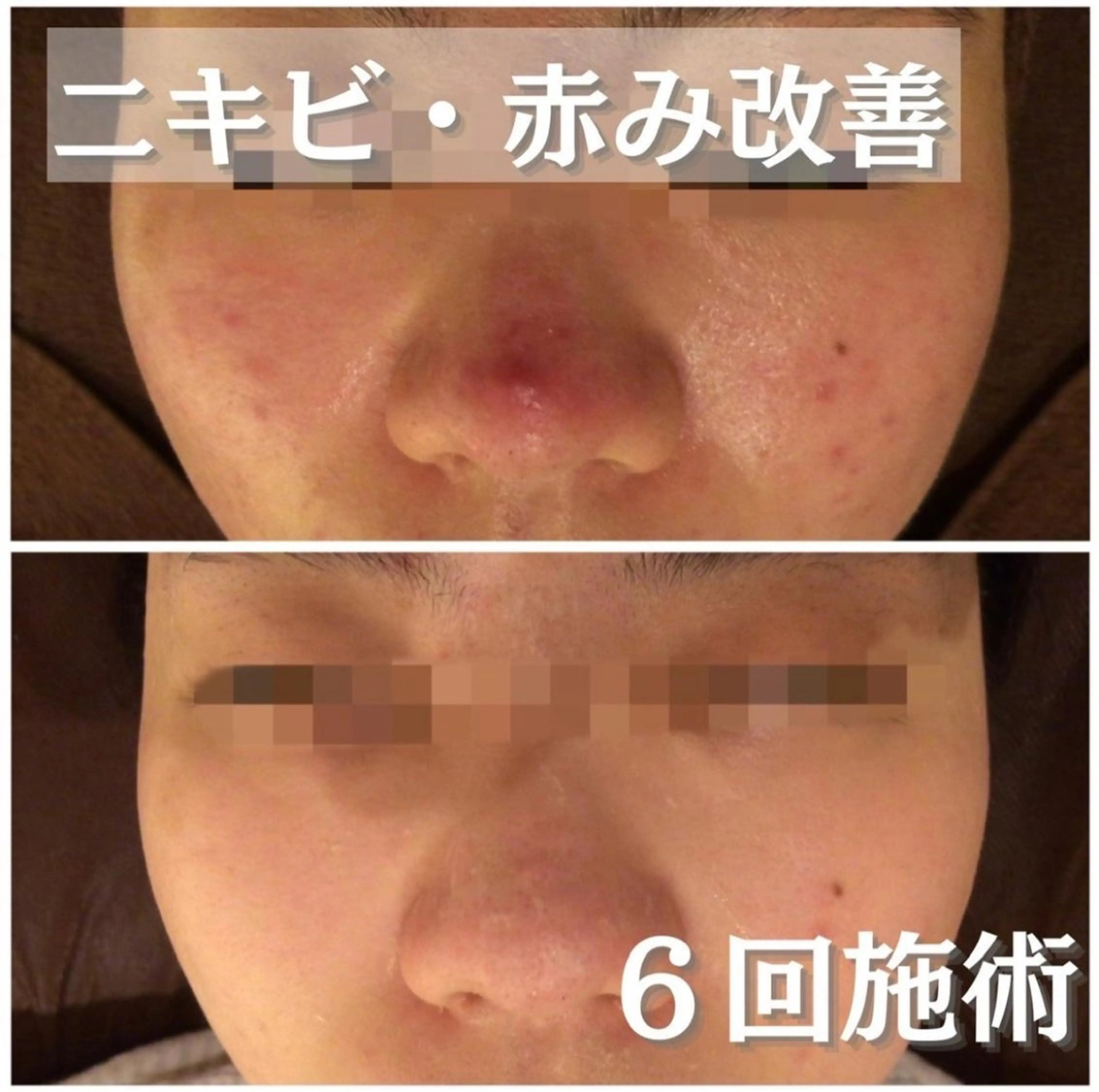 【3週間以内のリピーター様向け🪄】ニキビ・毛穴レスになれる肌質改善フルコース お得な2回目クーポン🎁の写真