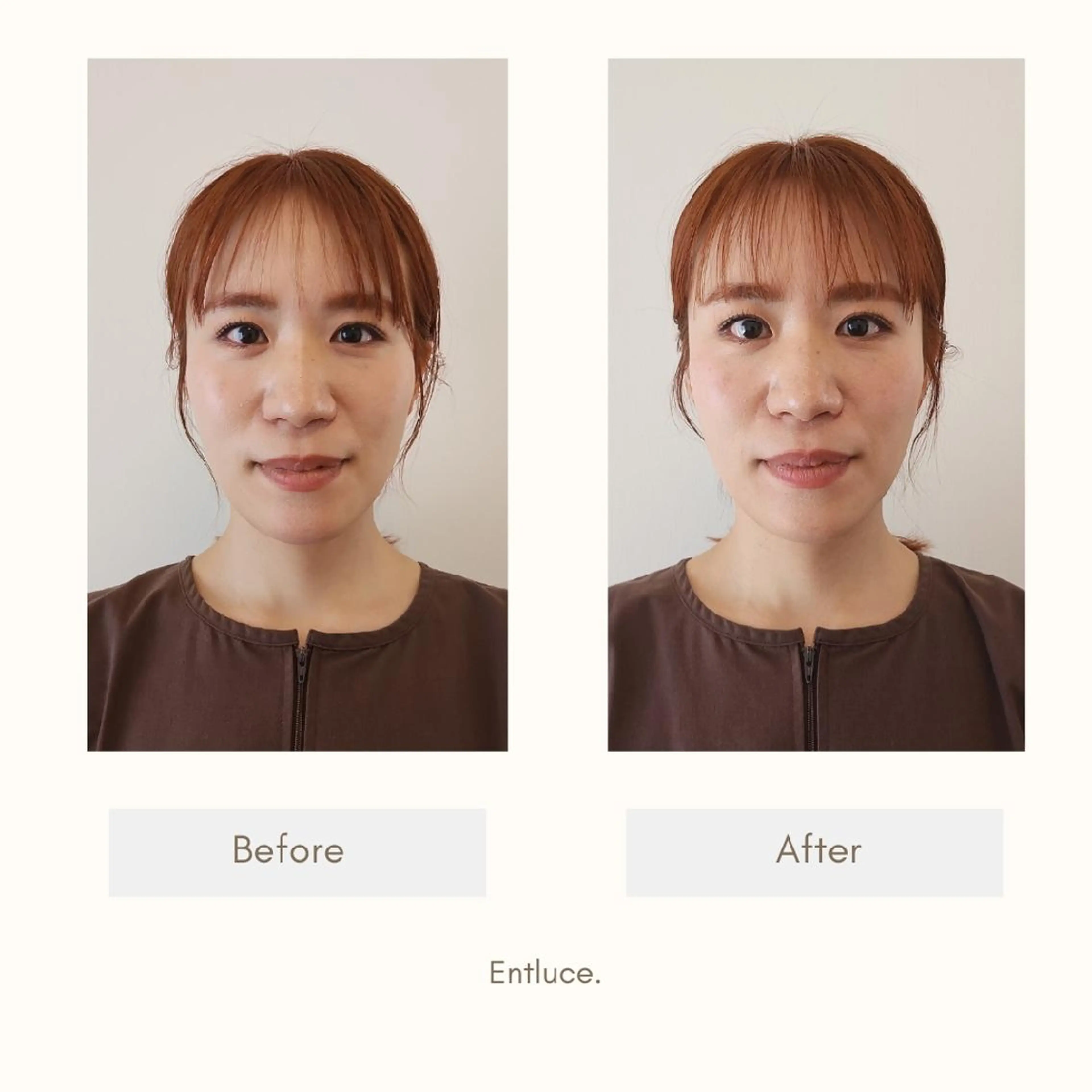 エステ リラク 即効⚡小顔美容鍼🪡 むくみたるみ脂肪解消のエステ・リラクイメージ