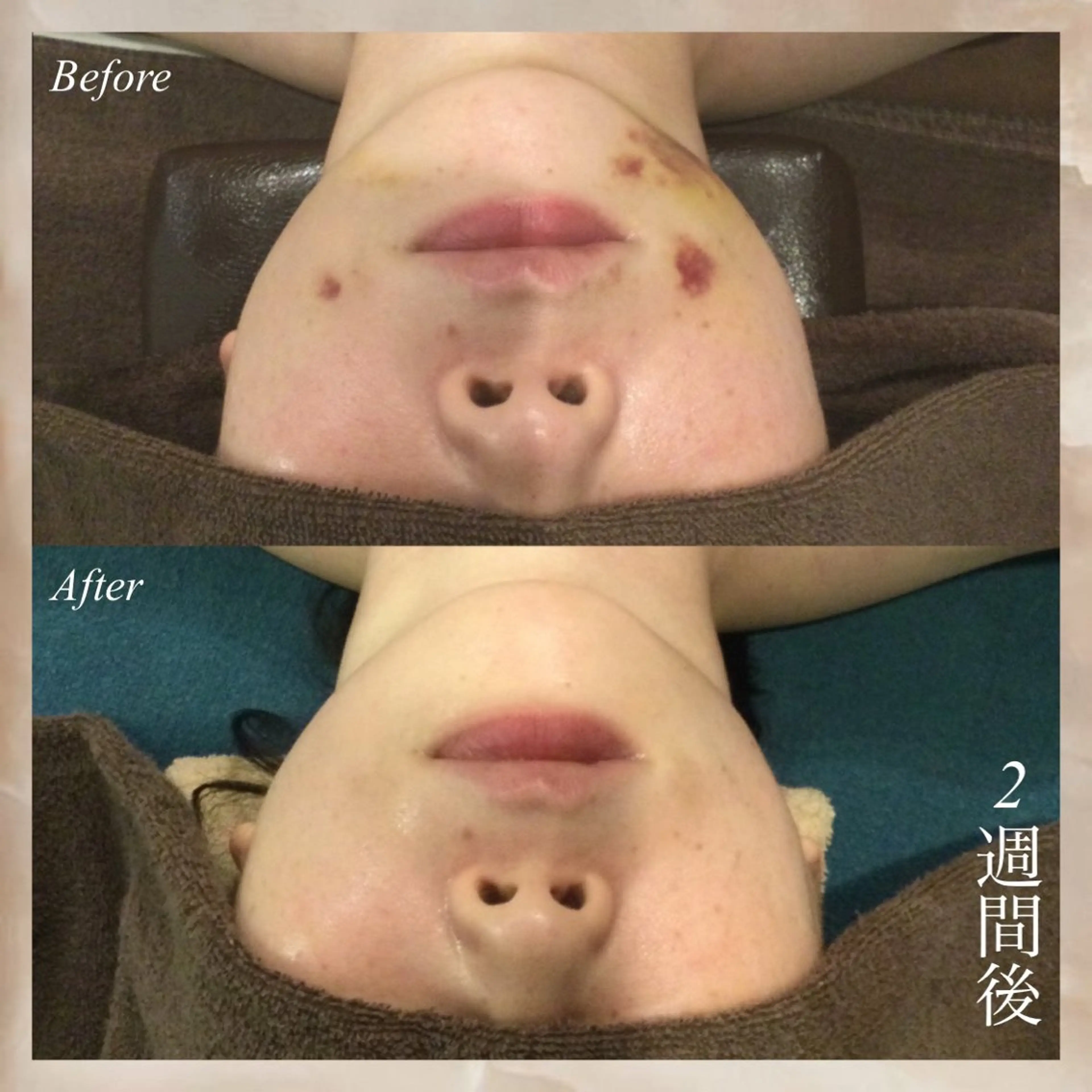 【平日限定】15分顔術後ケア 2000円【ボディ不可】◆15分1500円の写真