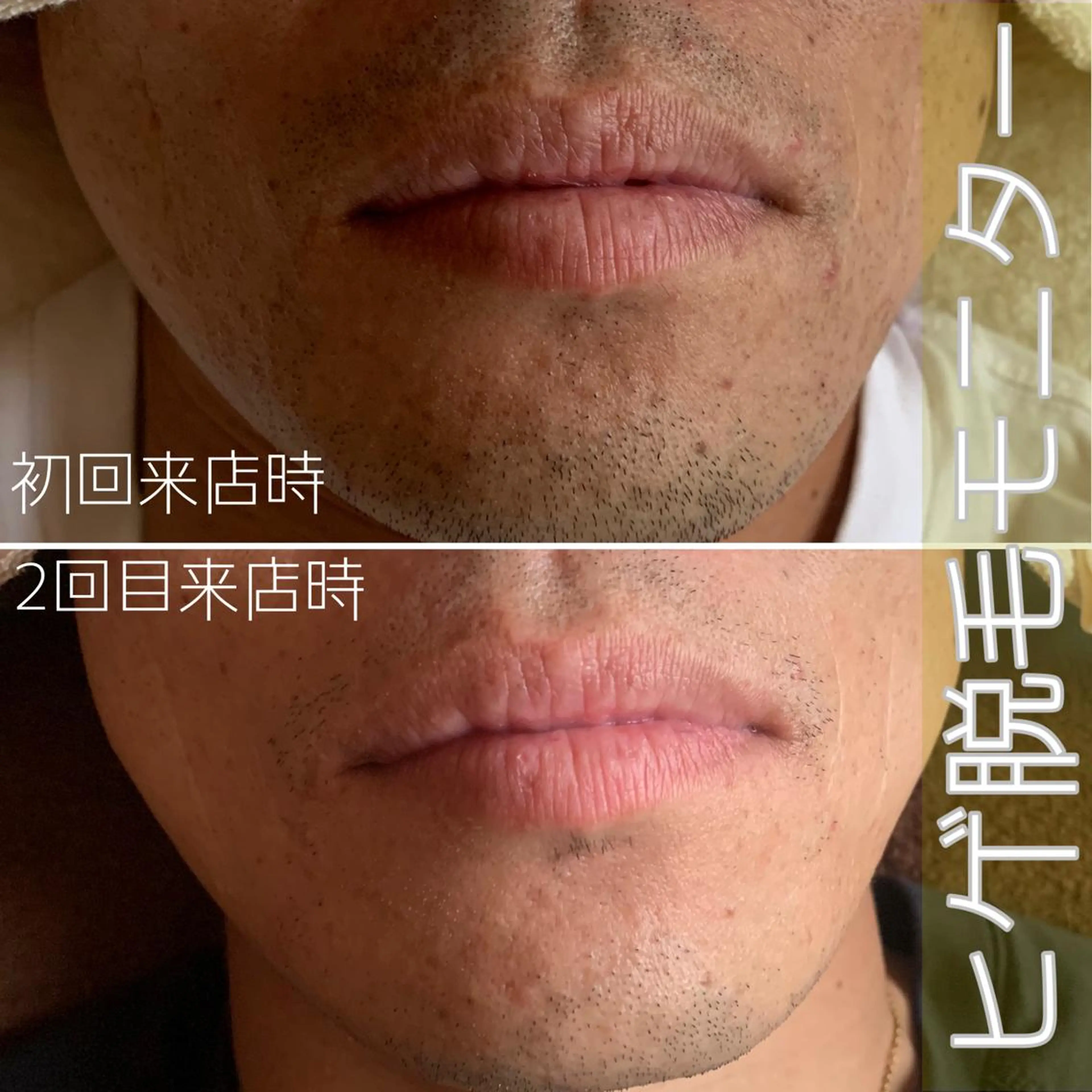 [初回]メンズヒゲ脱毛モニター💆🏻‍♂️※定員埋まり次第掲載終了⚠️メンズもツルスベ肌をスタンダードに❣️の写真