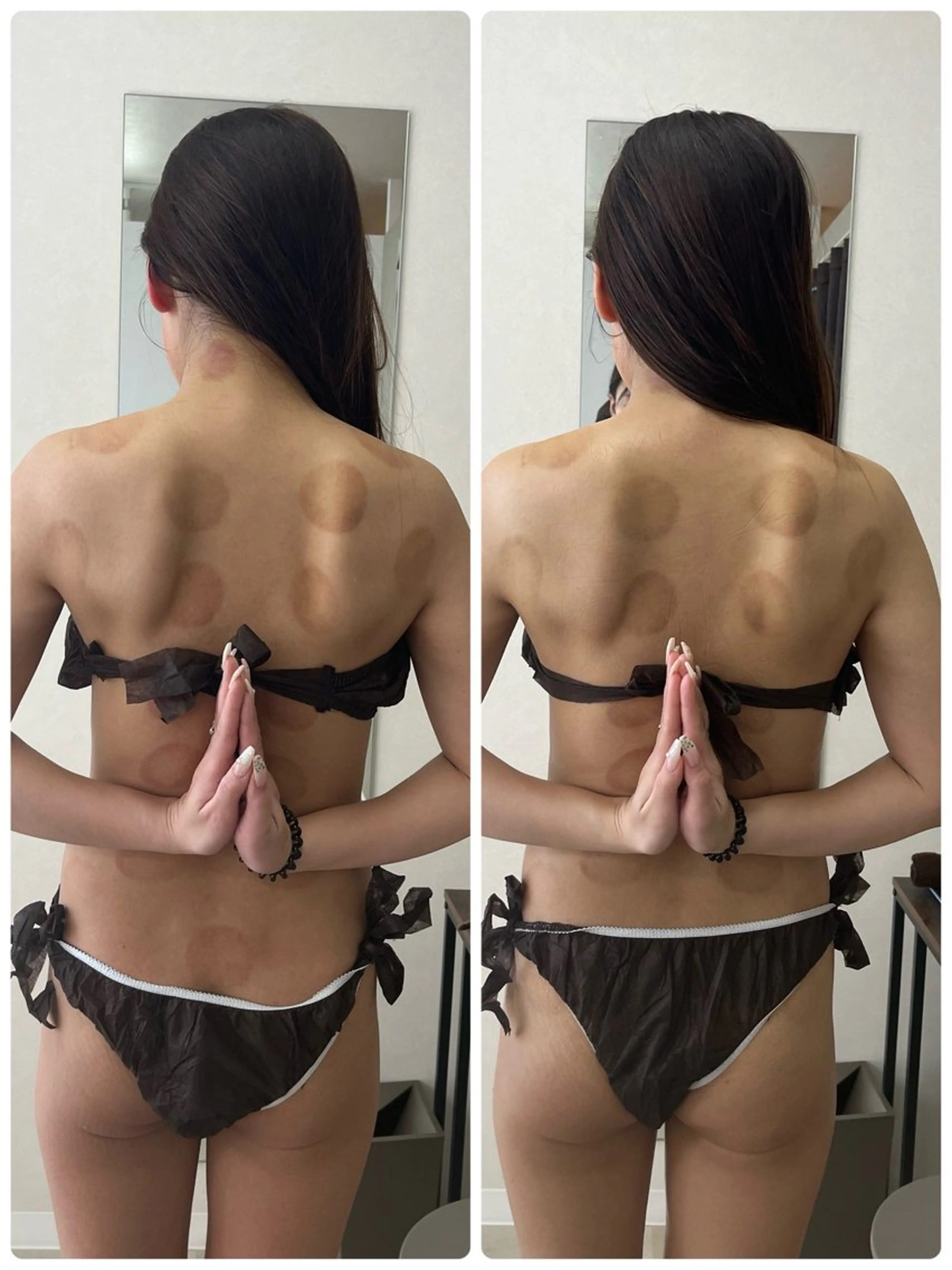 針を使わない脂肪撃退20ml✨ 💕選べるお身体2部位専用💕の写真