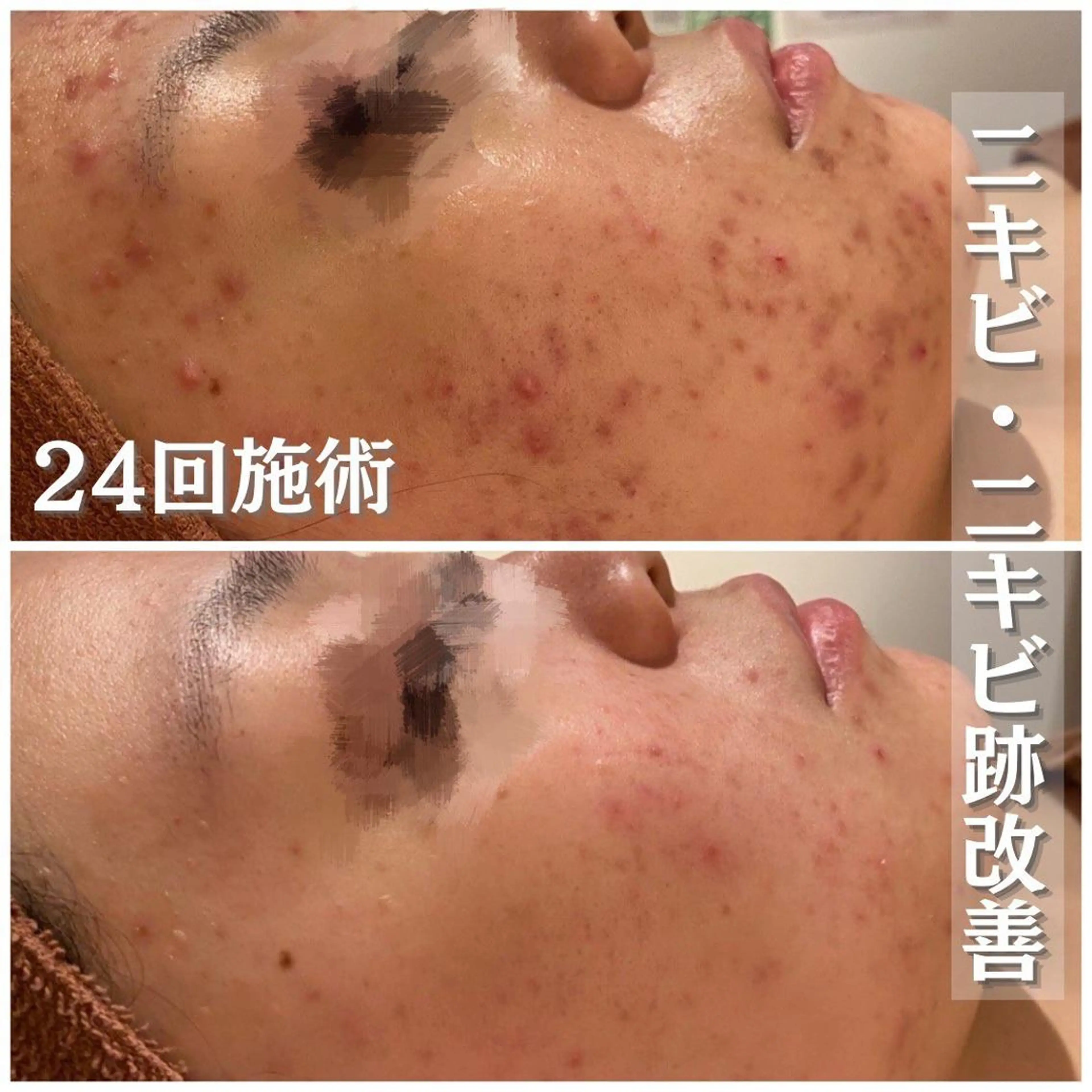 ロング カラー パーマ ヘアアレンジ メンズ キッズ ネイル マツエク・マツパ アイブロウ 🔥3か月で肌革命 🔥ニキビ専門店のエステ・リラクイメージ