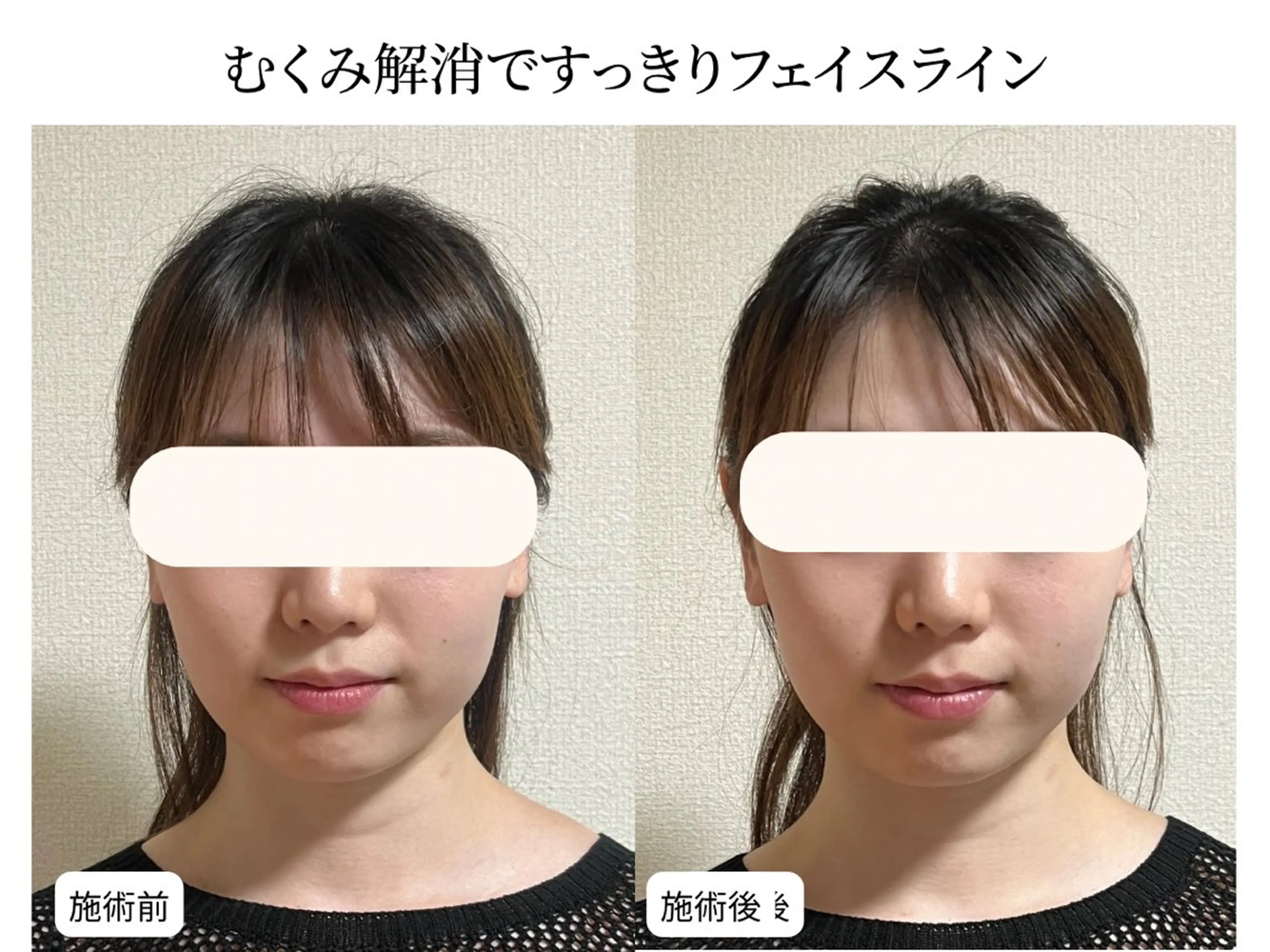 エステ 毛穴ケア専門サロン＆ドライヘッドスパ【毛穴洗浄 | ララピール】DREAM SPA町田店所属・小顔矯正×毛穴サロン DRRAMSPA町田のエステ・リラクイメージ