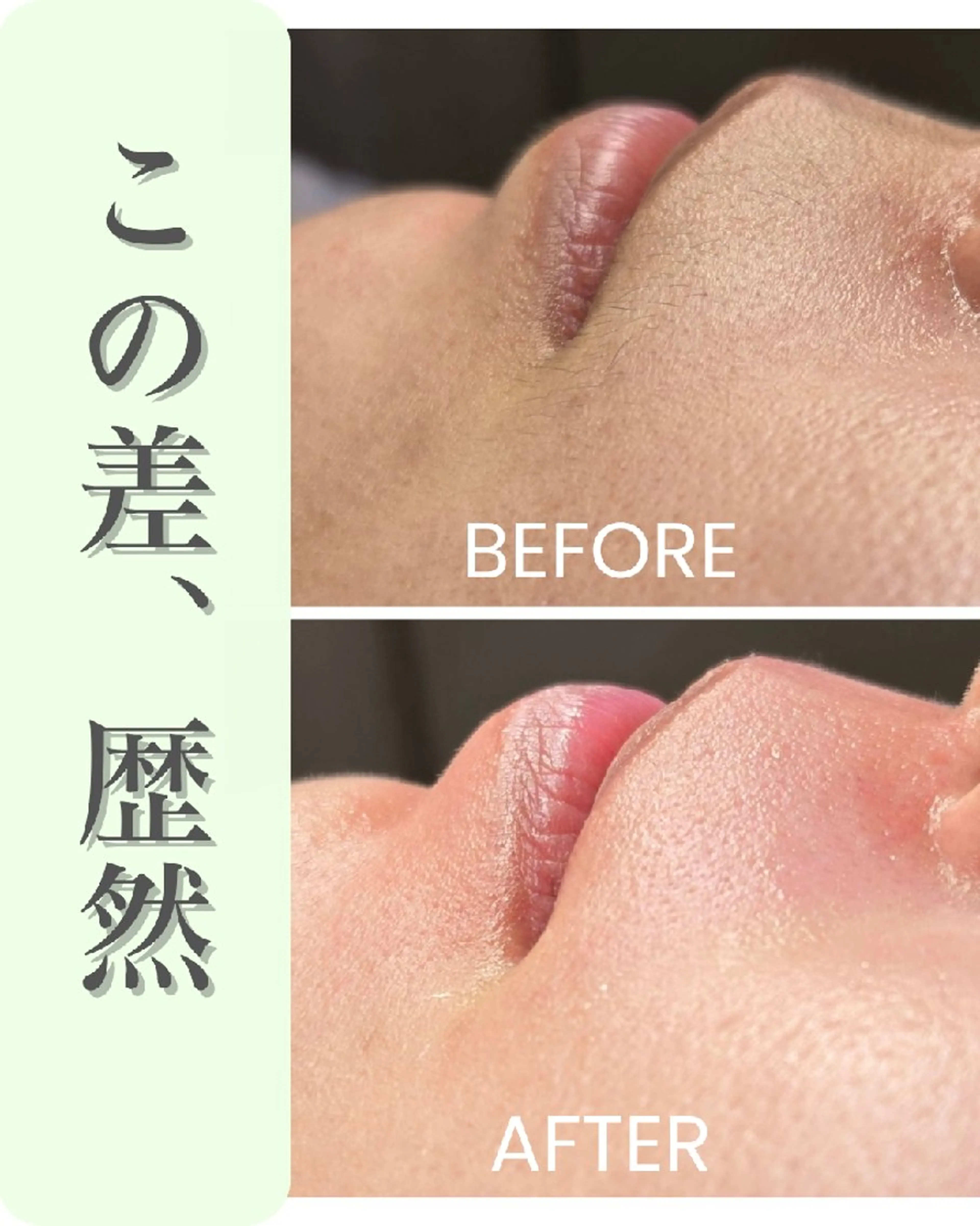 お試しフェイシャルwax　口まわりの写真