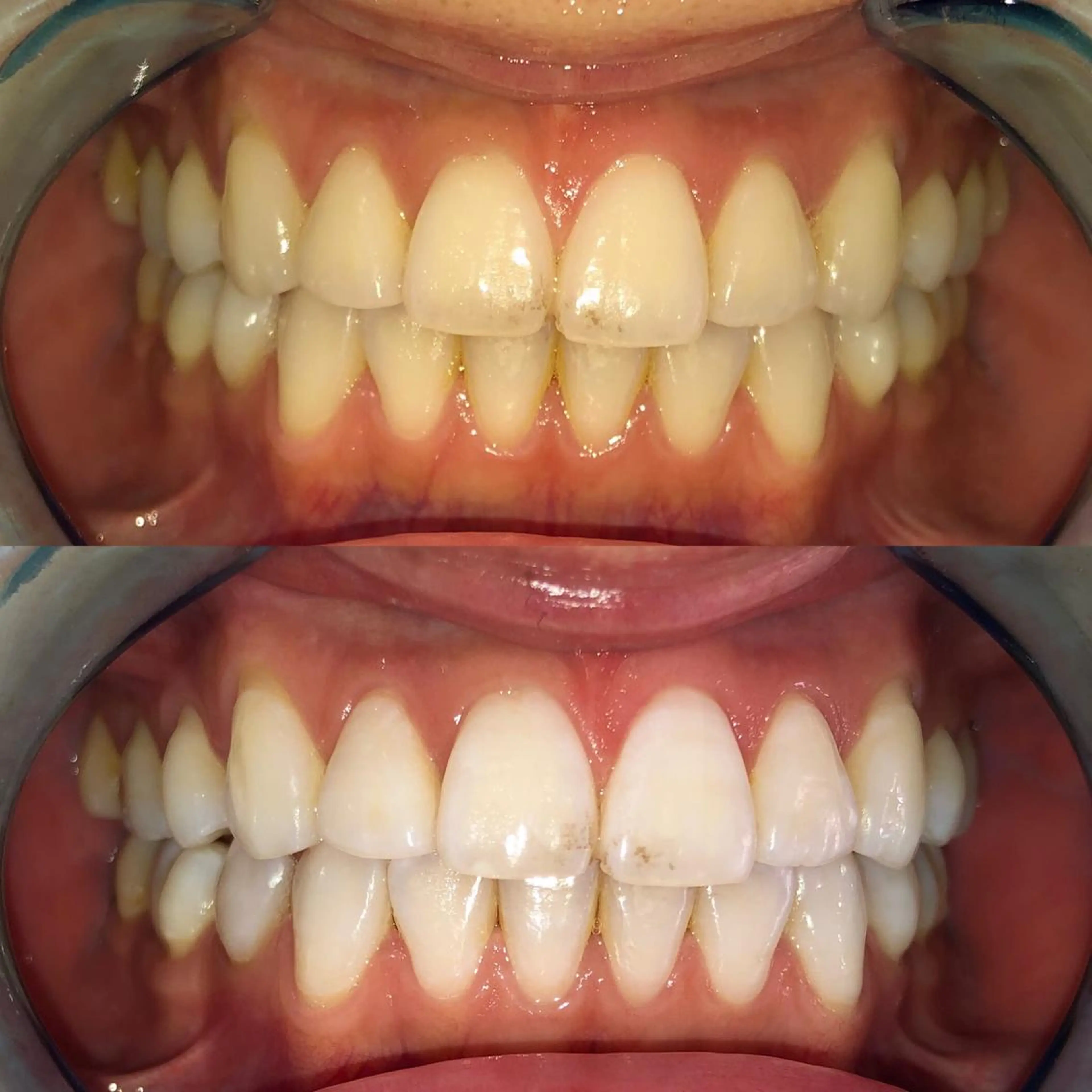 メンズ ネイル マツエク・マツパ アイブロウ ホワイト 【ハーブ×毛穴洗浄】 THE MORE千葉のエステ・リラクイメージ