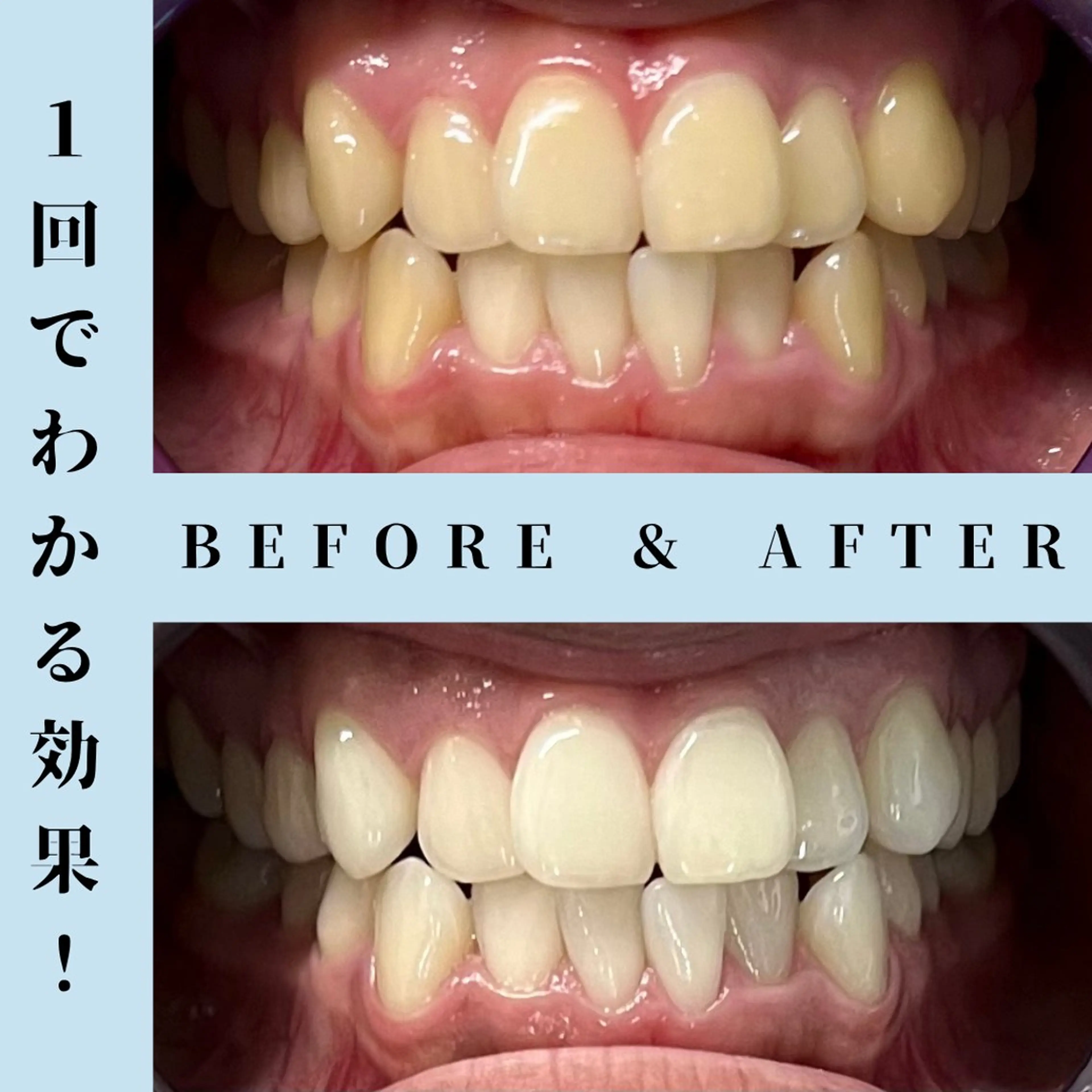 メンズ その他 セルフホワイトニング Dolce水戸店のその他イメージ