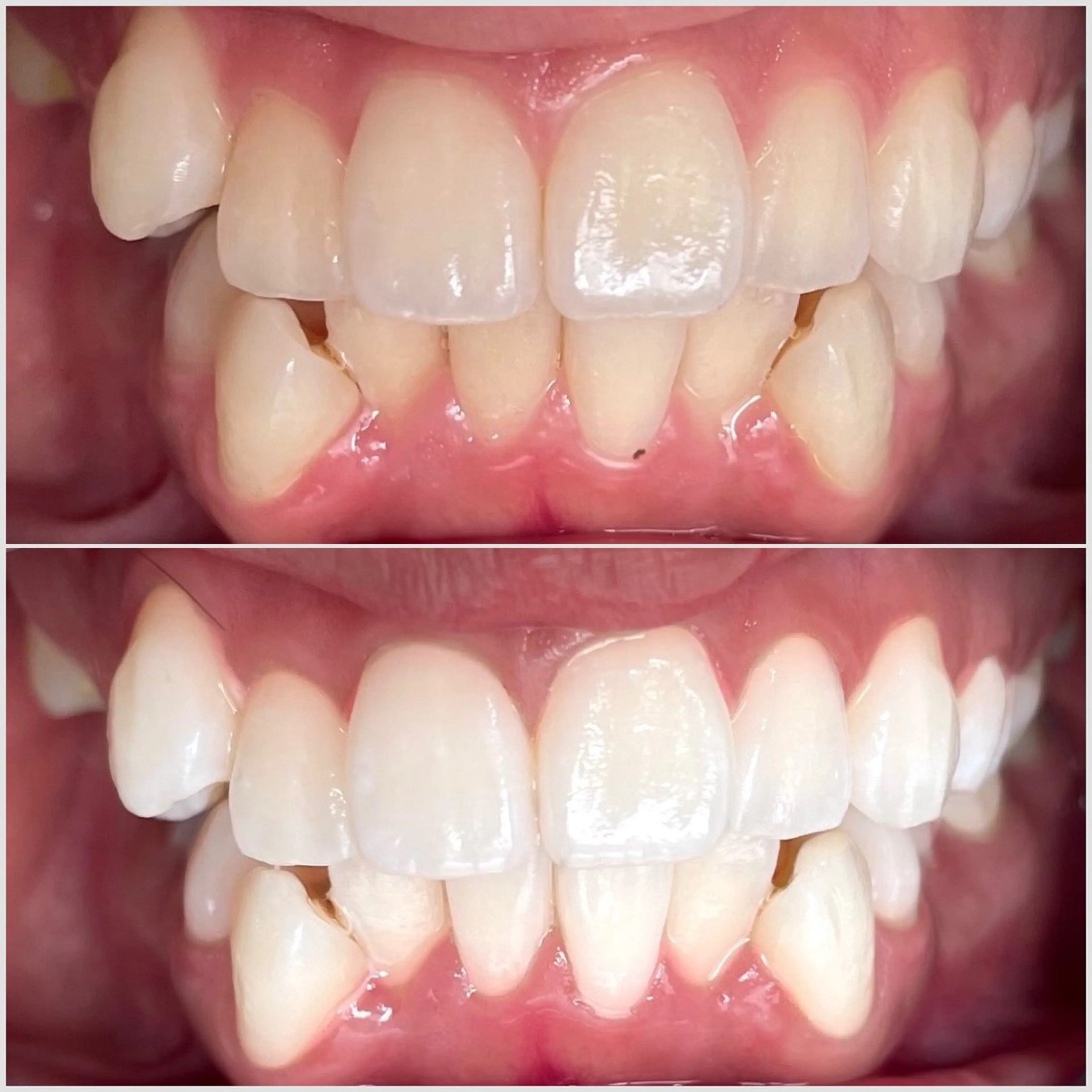 【歯の黄ばみに🦷】まずはお試し😊8分×3回で透明感ある自然な歯に🌿人目を気にせず自分磨き💖ホワイトニング🦷の写真