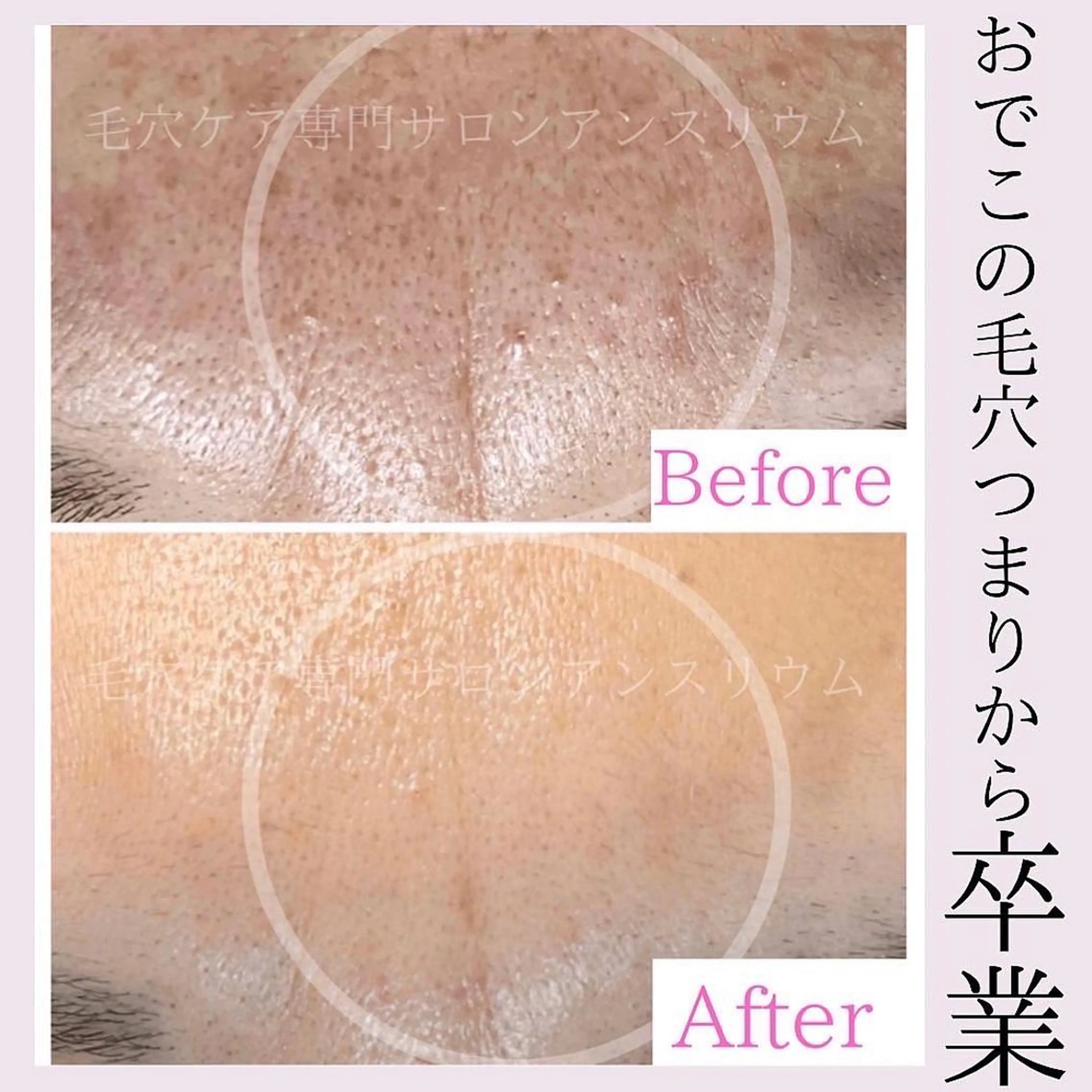 毛穴ケア専門サロンアンスリウム所属・茨城土浦 つくば毛穴 ケア専門サロンのエステ・リラクイメージ