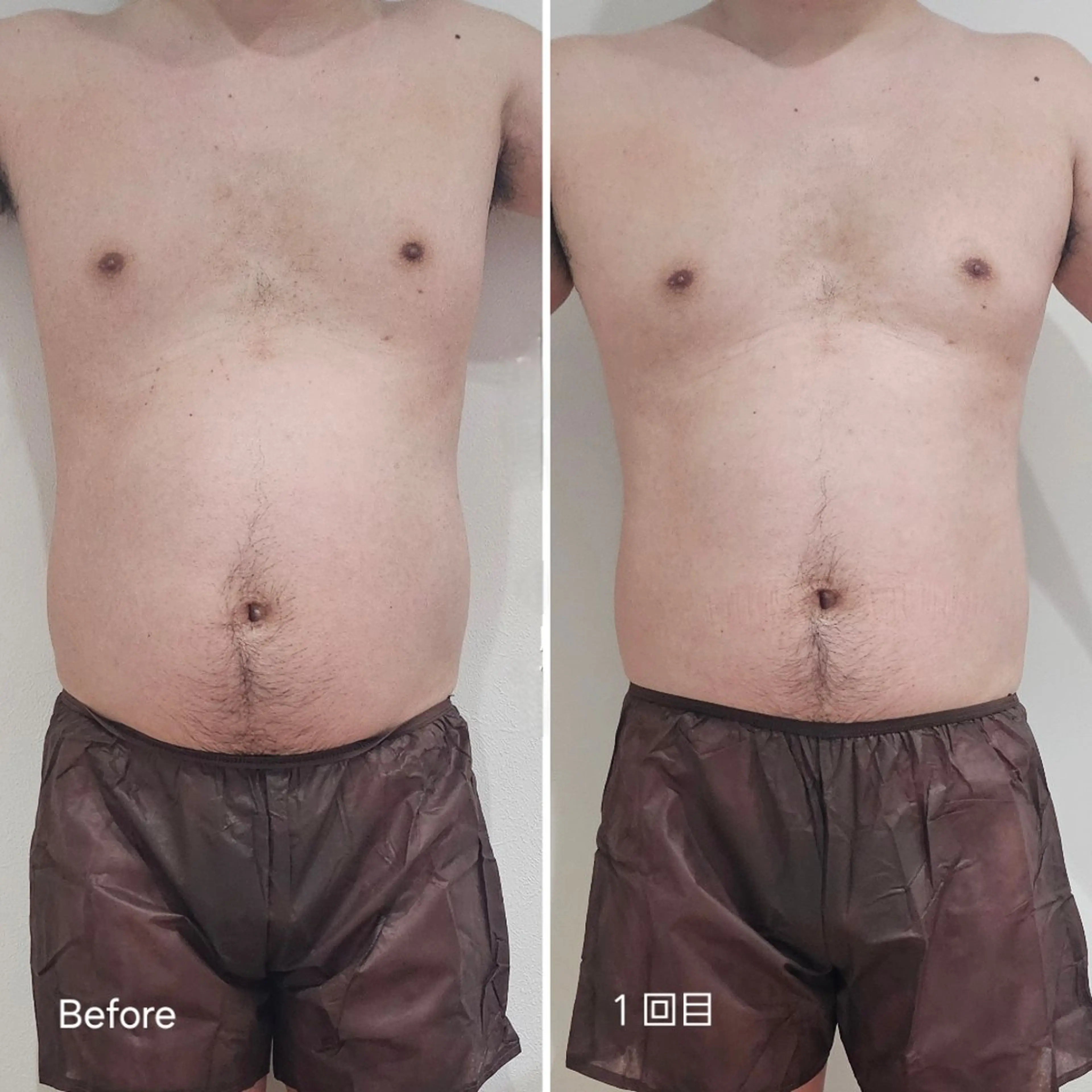 脂肪冷却 & 脱毛 AYUMIのその他イメージ