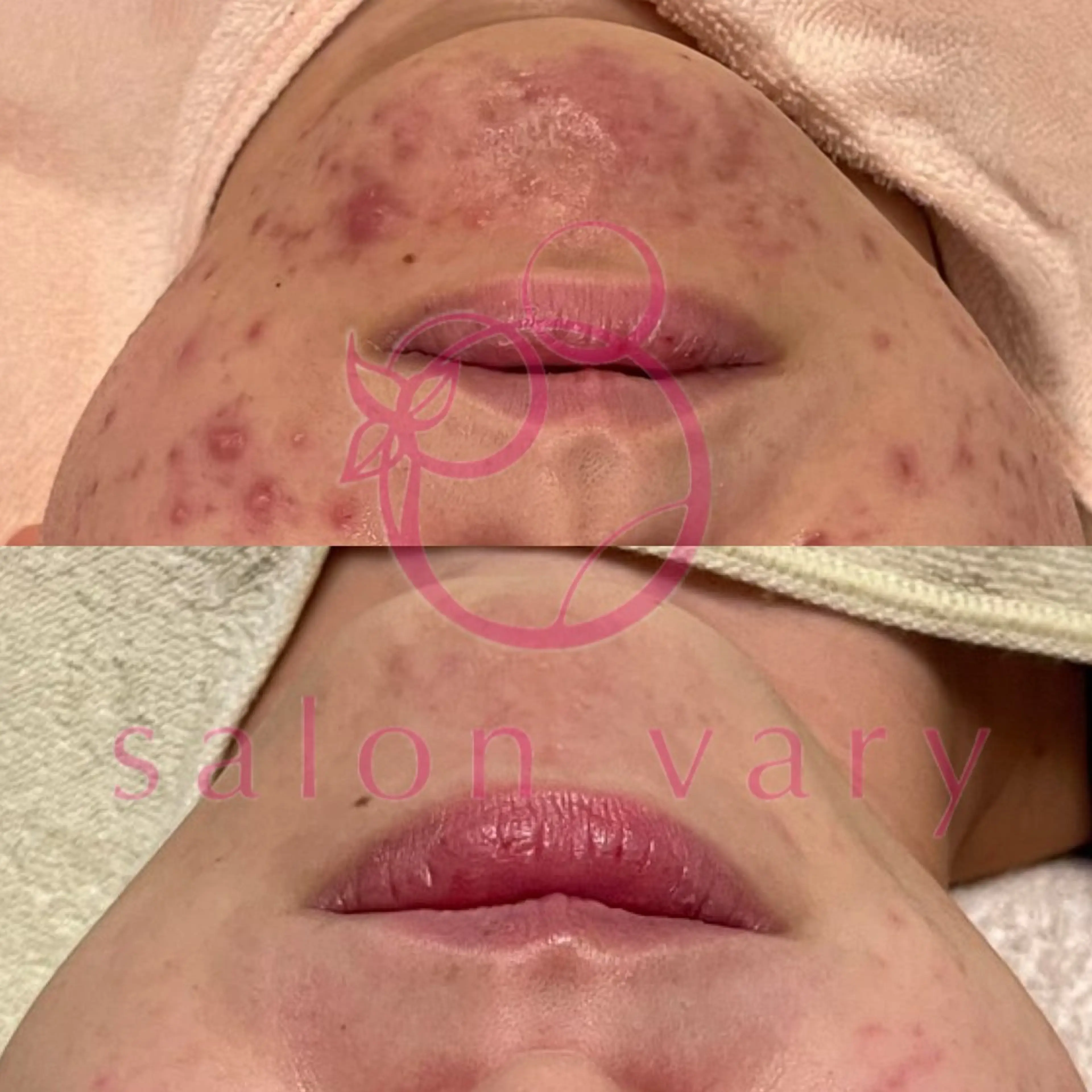 【ニキビ/肌管理】 salon varyのエステ・リラクイメージ