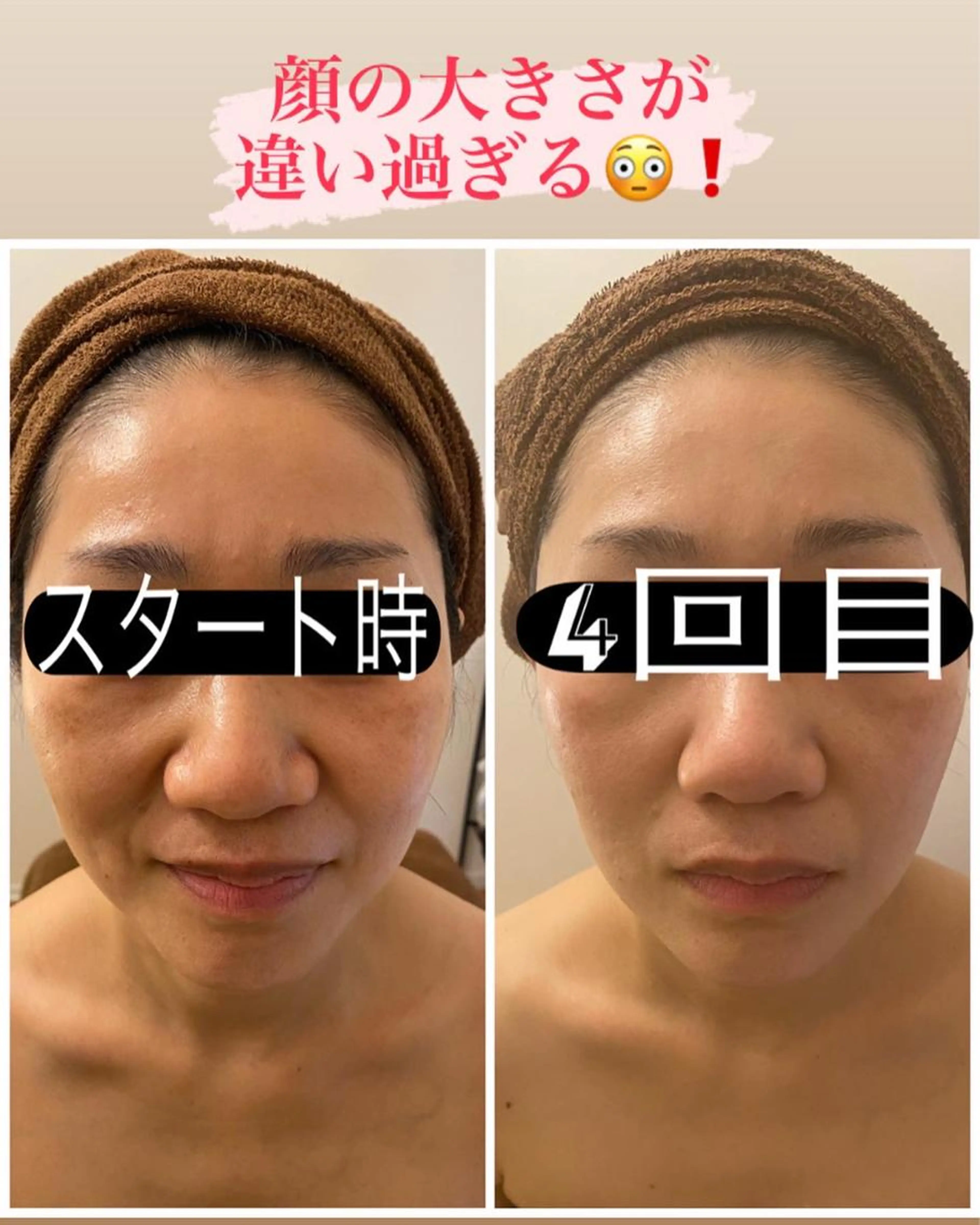 【速攻小顔】凝り固まった表情筋をほぐし引き締め⤴️セルライトゼロフェイシャル💕二重アゴの脂肪にもアプローチ！毛穴引締めの写真