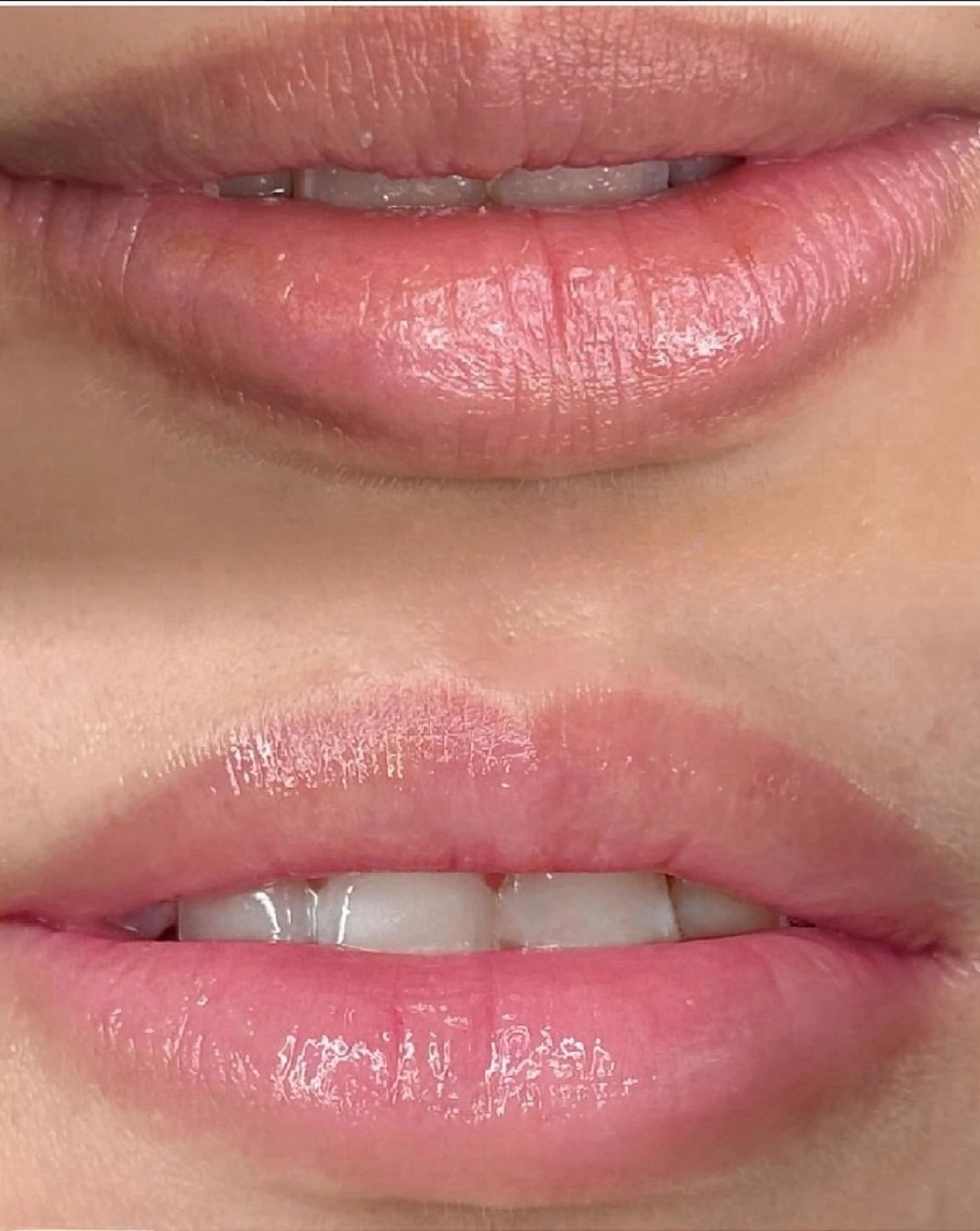 医療提携Ruby所属・医療提携Ruby小顔 ハーブピーリングのその他イメージ