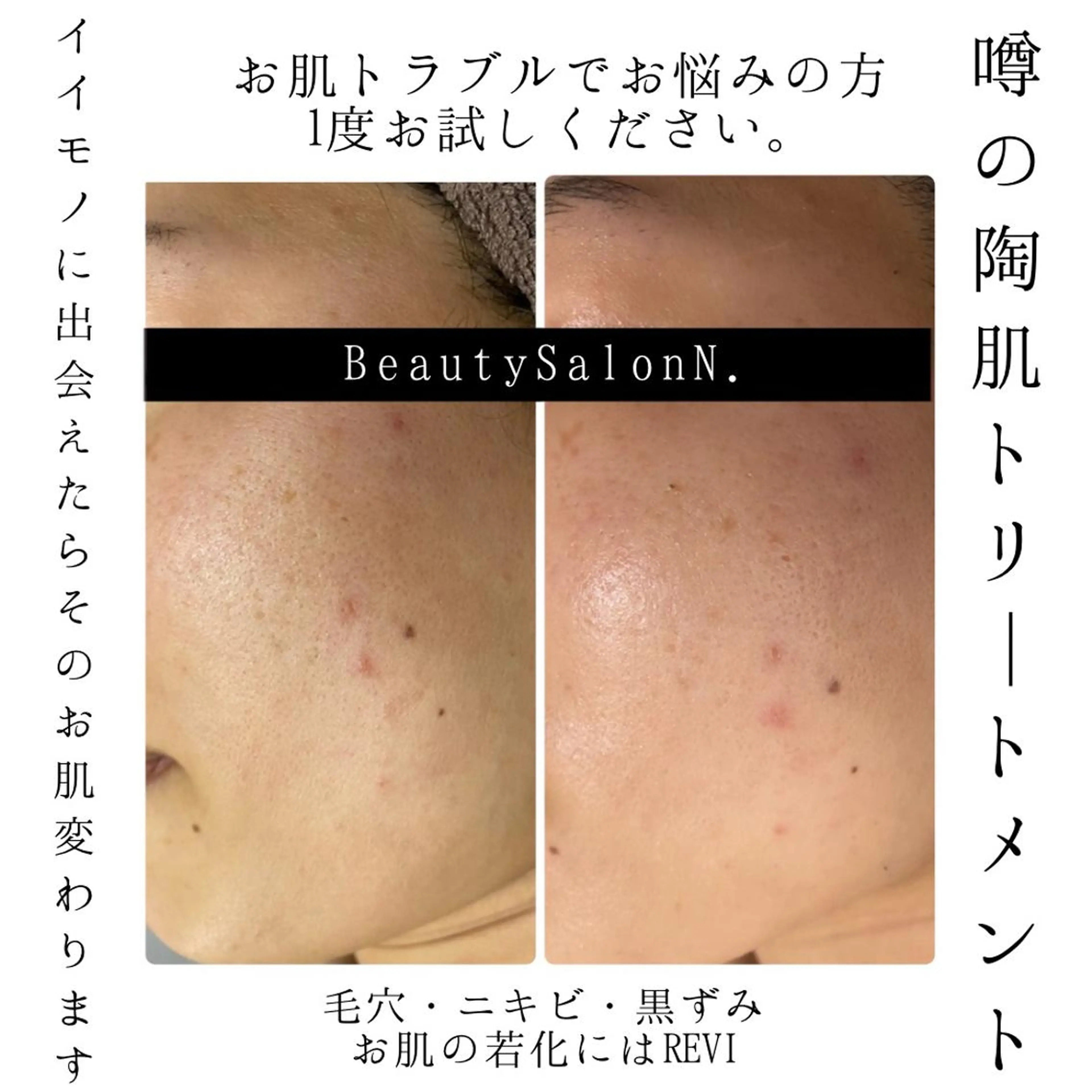 REVI 陶肌トリートメント🌿ベースパウダー1g＋オプション1g【初回お試し】の写真