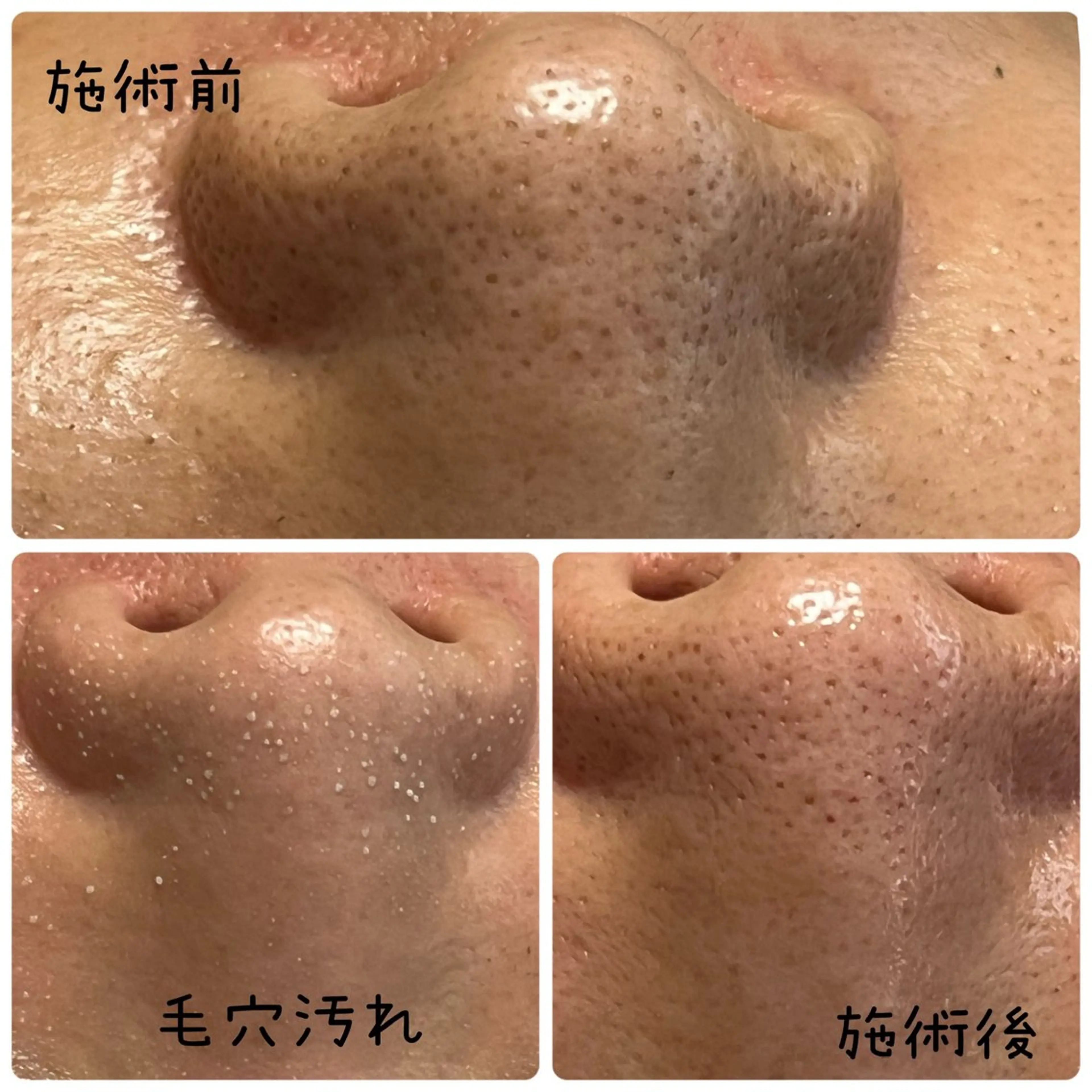 【スキンケア浸透率UP♪】痛くない毛穴洗浄★の写真