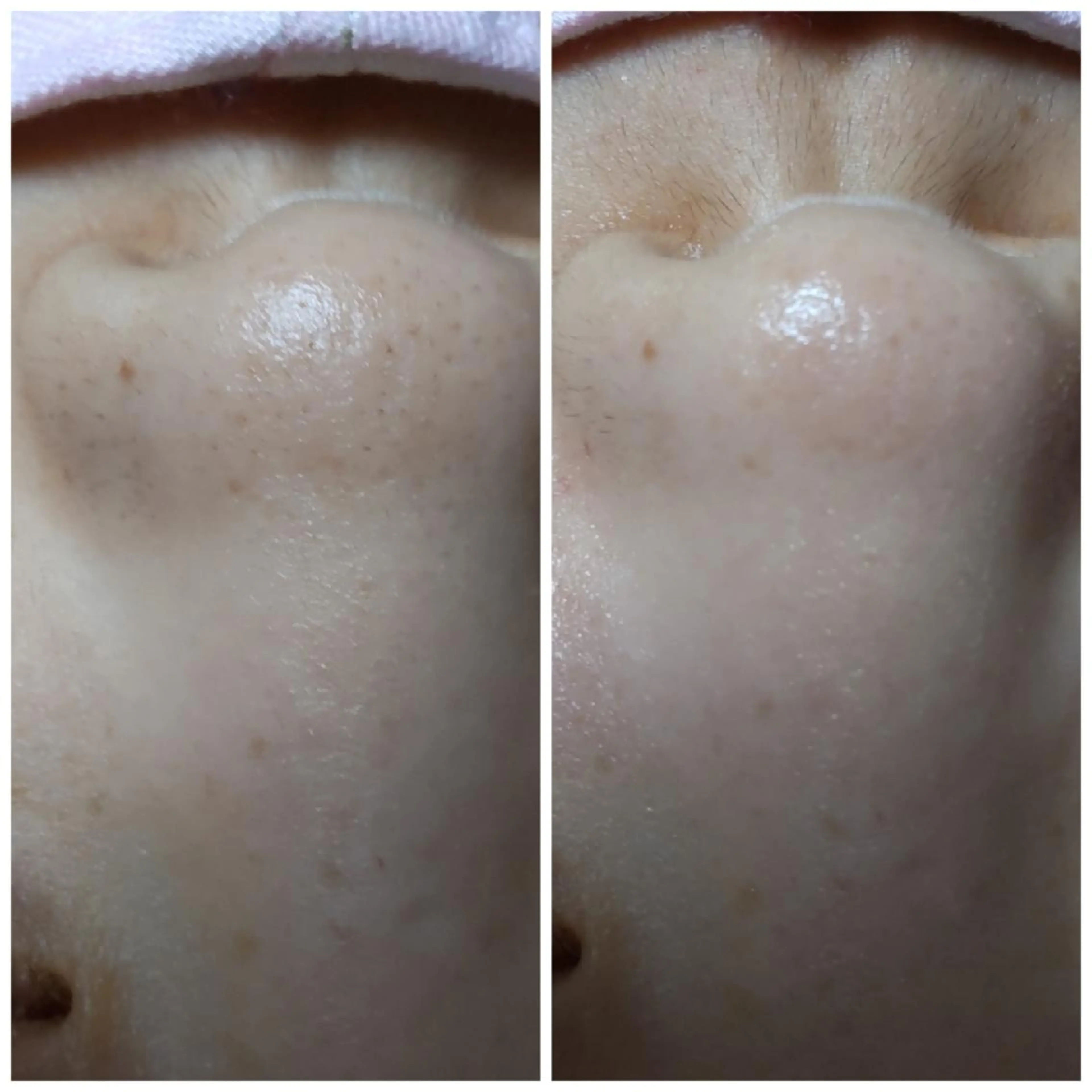 黒ずみ毛穴スッキリコースの写真